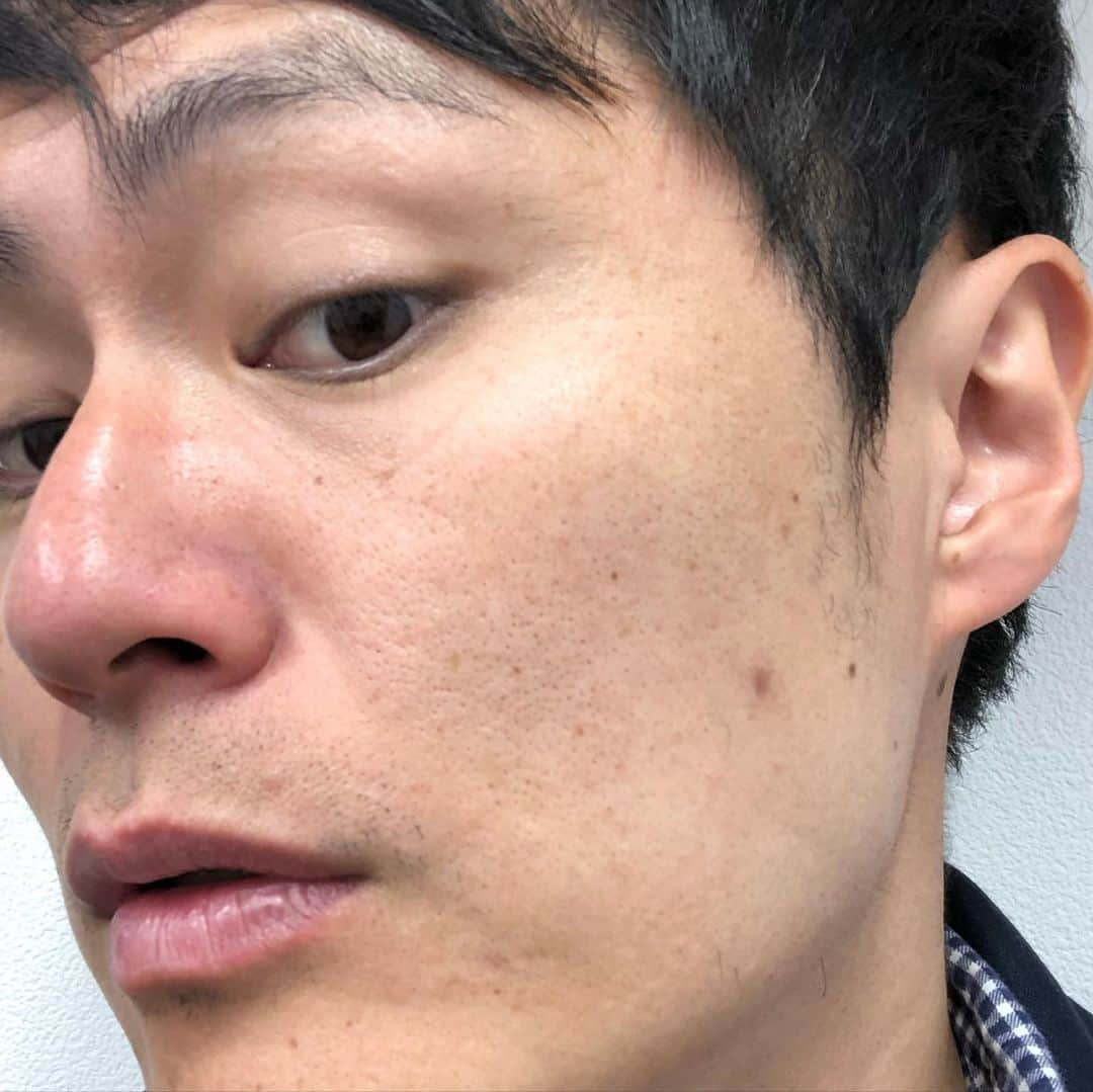 梅村賢太郎さんのインスタグラム写真 - (梅村賢太郎Instagram)「ゴリラ洗顔させて頂きました！ 施術前→施術後 を交互にこちらアップしてます スワイプして見てみて下さい！ トーンがあがりました！ すごい！ 7枚目は元々透明やったものに 僕の顔の汚れが入ったもの💦 グレープフルーツジュースくらいなった！ 失礼します😢  #ゴリラクリニック #心斎橋 #梅田 にもできるそうです 施術前に相談受けてくれはるから安心！ お肌ケアの方法も教わりました！ ありがとうございました！  スタッフの方々がまた美人様 はい。僕しどろもどろ。」11月12日 19時56分 - rahujigenume