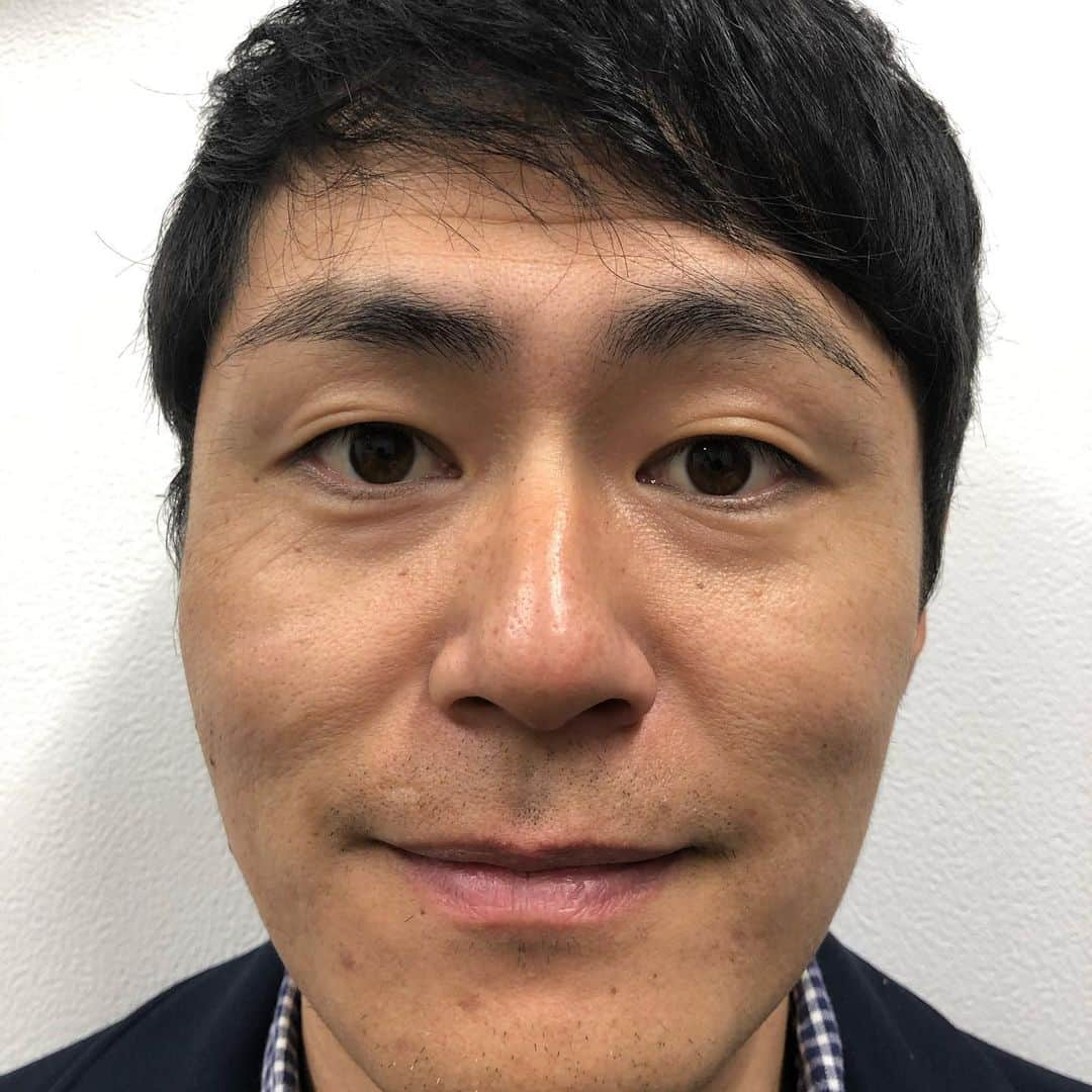 梅村賢太郎さんのインスタグラム写真 - (梅村賢太郎Instagram)「ゴリラ洗顔させて頂きました！ 施術前→施術後 を交互にこちらアップしてます スワイプして見てみて下さい！ トーンがあがりました！ すごい！ 7枚目は元々透明やったものに 僕の顔の汚れが入ったもの💦 グレープフルーツジュースくらいなった！ 失礼します😢  #ゴリラクリニック #心斎橋 #梅田 にもできるそうです 施術前に相談受けてくれはるから安心！ お肌ケアの方法も教わりました！ ありがとうございました！  スタッフの方々がまた美人様 はい。僕しどろもどろ。」11月12日 19時56分 - rahujigenume