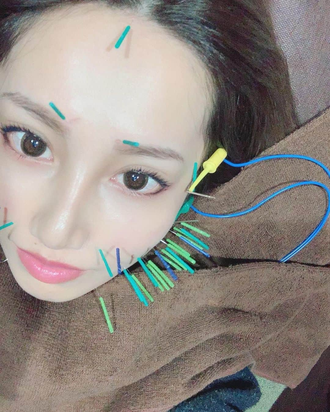 ひよこ先輩さんのインスタグラム写真 - (ひよこ先輩Instagram)「光り輝くデコ🐥🐥🐥 最近はずっと自まつ毛メイクだから ナチュラルなコンタクトにしてる🐥 今週も行ってまいった！【@b_carat.bykoritorinic】 こんなに定期的に毎週かかさず 通ってるのは美容鍼だけ🥺 初回はお得に行けるので予約は 【 @sugizakikenya 】にDMすると 詳しく教えてくれると思います🥺🥰 . #きゅきゅっと美容鍼 #BCARAT式美容鍼 #BCARATbykoritorinic #BCARAT #Beauty #Body #Balance #笹塚 #笹塚美容鍼 #美容鍼 #美顔鍼 #新宿」11月13日 21時18分 - piyo14ko