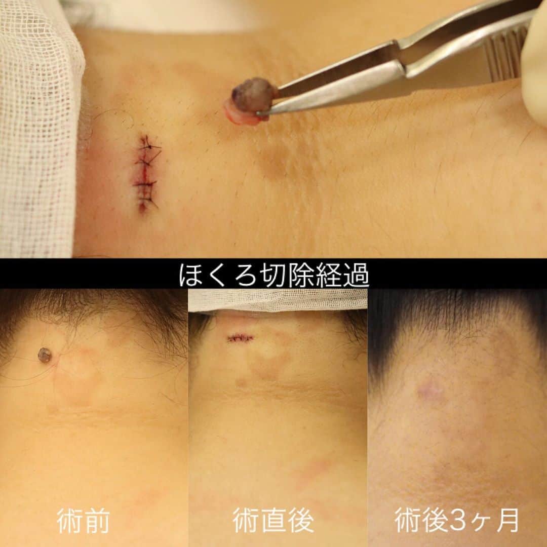 東京イセアクリニックさんのインスタグラム写真 - (東京イセアクリニックInstagram)「ホクロの除去手術👨🏻‍⚕️✨ . 【首の後ろにあるホクロを取りたい】 と言ったご希望の患者様🗣🗣🗣 ↓↓↓↓↓ 担当医師:スズキ . . 6ヶ月から1年程で、傷跡は殆ど分からないものに👼🏻✨ 3ヶ月でもほとんどわからないくらいになりました✨ . レーザーで除去できるホクロもありますが 大きく隆起したものは、凹みや再発のリスクのない 【切除】が適応になります👩🏻‍⚕️💉 . 😷痛み・内出血:数日 🤕抜糸:7-10日後 ⚠️瘢痕のリスク 👛1mm幅 ¥12000税抜 (サイズによって異なります) . 少し老けた印象に見える首の後ろやうなじのホクロ ホクロがある・ないで印象は激変しますっ😳🌟 . 患者様にとって1番綺麗に除去出来る方法を ご提案いたします✨ . 医師によるカウンセリングは無料です🌟 お気軽にお問い合わせ下さい💁🏼‍♀️💁🏼‍♂️ . #銀座#ginza  #plasticsurgery #cosmeticplasticsurgeon  #iseaclinic#イセアクリニック #美容#整形#美容皮膚科 #女医 #ウルセラリフト#ウルセラ#HIFU#超音波 #ホクロ#ホクロ除去#co2#レーザー #たるみ#たるみ改善#コラーゲン #リフトアップ#美肌#肌活#陶器肌  #若返り#アンチエイジング  #綺麗になりたい#可愛くなりたい」12月10日 20時02分 - iseaclinic