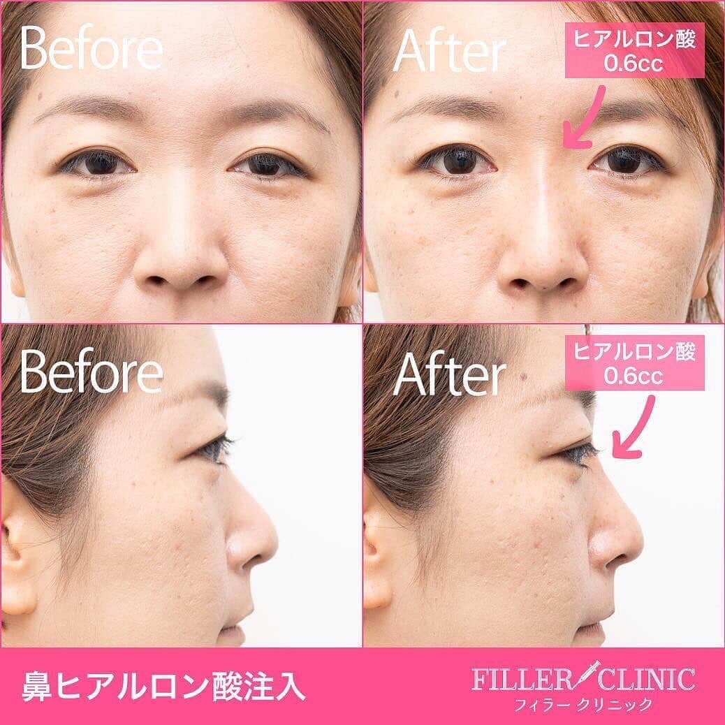 恵比寿フィラークリニックさんのインスタグラム写真 恵比寿フィラークリニックinstagram ピーンと通った鼻筋でハーフ顔が作れる 鼻ヒアルでいつものメイクが可愛さアップ 治療後そのままお化粧をしてお出かけもできちゃいます お顔に立体感が出る