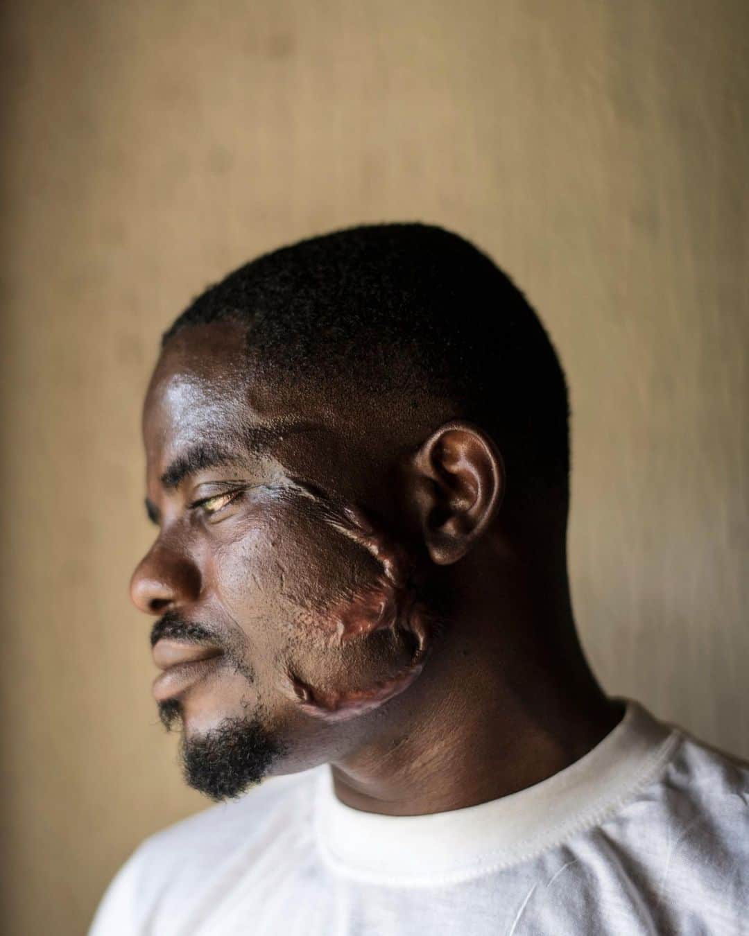 のインスタグラム：「Photos by @lynseyaddario | Sunday, 29, shows the scars on his face after returning to Nigeria with other Nigerians who tried to make their way to Europe but ended up enslaved, beaten, assaulted, and trapped in Libya. Taken at a shelter in Benin City, Nigeria, March 2018. Sunday is from Benin City, and left for Europe in February 2016 after paying hundreds of dollars; he ended up in Libya for over two years, where he was bought and sold off and beaten repeatedly. During one torture session, a Libyan man set a knife on a fire and carved his cheek before he was sold off to another trafficker in Libya. The International Organisation for Migration facilitates and processes returnees in order to help them get safely back to their country of origin. Due to lack of opportunity, Nigeria is one of the major source countries of African migrants to Europe. To see more of my work, follow @lynseyaddario.」