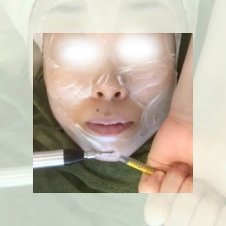 のインスタグラム：「🔻メソナJプラス﻿ ﻿ 痛くない水光注射😊﻿ ﻿ ❌注射が苦手﻿ ❌麻酔クリームが合わない﻿ ❌ダウンタイムが取れない﻿ ﻿ そんな方に…﻿ 水光注射並みの効果で﻿ 注射でしか注入できなかった成分が…﻿ ﻿ ⭕️注射なし﻿ ⭕️麻酔なし﻿ ⭕️ダウンタイムなし﻿ ﻿ で、注入できます⤴️﻿ ﻿ ﻿ ‼️オラクル完全オリジナル‼️﻿ ﻿ 💎ボトックスカクテル﻿ 💎リジュラン﻿ 💎幹細胞﻿ 💎トラネキサム酸﻿ 💎BNLS（脂肪溶解）﻿ ﻿ 直後からお肌が変わります。﻿ ﻿ ﻿ ⭐保湿コース 20,000円【11月限定！全員対象】﻿ ⭐美白（トラネキサム酸）35,000円﻿ ﻿ ⭐ハリ・毛穴（ボトックスカクテル）﻿ 40,000円﻿ ﻿ ⭐ハリ・保湿（リジュラン）﻿ 50,000円﻿ ﻿ ⭐肌再生（リジュラン、幹細胞）﻿ 52,000円﻿ ﻿ ⭐BNLS（脂肪溶解・小顔）3本 ﻿ 40,000円﻿ ﻿ ⭐BNLS（脂肪溶解・小顔）5本﻿ 43,000円﻿ ﻿ ﻿ #オラクル美容皮膚科 #オラクル #oracle #メソナjプラス #水光注射 #保湿 #保湿ケア #美白 #美白ケア #毛穴 #毛穴ケア #肌再生 #bnls #小顔 #小顔になりたい #美容 #美容部 #美容好き #美容すきな人と繋がりたい #美容オタク #美容オタクさんと繋がりたい #韓国美容 #韓国 #🇰🇷」