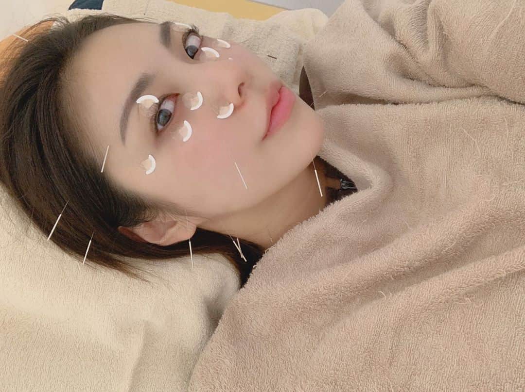 池田ゆりのインスタグラム：「私が週一でメンテナンスしてるアキバ整骨院ではじめて美容鍼してきました💕  目の周りはアザにならないように置き鍼にしてくれたよ✨ 輪郭もすっきりして、顔色もよくなった☺️☺️ 治療も素晴らしくて、先生も素敵で 居心地がよくて最近「ただいま」って言いそうになっちゃう🥺🥺 わたしの恵比寿のおうち🏠笑  #美容鍼  #小顔矯正 #アキバ整骨院 #恵比寿 #美容 #beauty #メンテナンス #bodycare  #fitness #protein #beauty #bodymake #instagood #todaystraining #gym #style #tokyo #도쿄 #피트니스 #이케다유리」