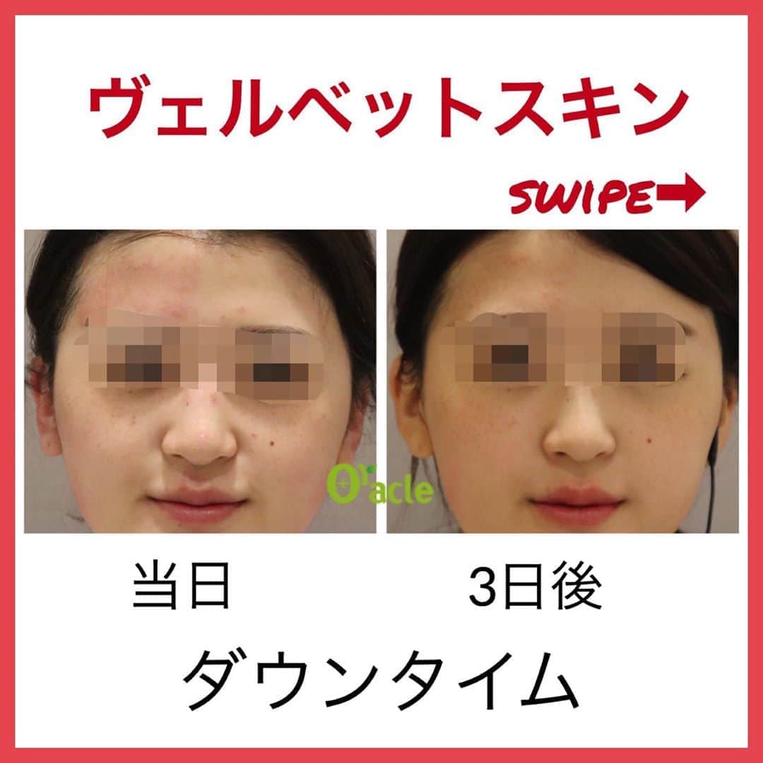 のインスタグラム：「🌹トライアルイベント実施中﻿ ﻿ 👠ヴェルベットスキン➡︎大好評🌹﻿ ﻿ 11-12月イベント  20%OFF﻿ 🌹トライアル48,000円（税抜）﻿ ※通常60,000円﻿ ﻿ ▪️▫️▪️▫️▪️▫️▪️▫️▪️▫️﻿ ﻿ ダーマペン4✖️コラーゲンピール﻿ ＝ヴェルベットスキン👠﻿ ﻿ 🥀お肌のハリ、弾力、艶がほしい﻿ 🥀より美肌効果の高い治療がしたい﻿ 🥀小ジワが気になる﻿ 🥀お肌の老化が気になる﻿ 🥀ニキビ跡が気になる﻿ 🥀毛穴の開きを改善したい﻿ ﻿ ダウンタイムが過ぎれば…﻿ ツヤツヤお肌に✨﻿ ﻿ ﻿ ▪️▫️▪️▫️▪️▫️▪️▫️▪️▫️﻿ ﻿ 🌹ヴェルベット ダウンタイム参考🌹﻿ ﻿ 写真がイメージです。﻿ 2日ほど赤みが出る方がいます。﻿ ※3日後の写真はノーメイクです。﻿ ﻿ 🌹ヴェルベットレポ🌹﻿ ﻿ （施術中）﻿ ダーマペンの針は、水光注射ほどの痛みは感じない。﻿ ピーリング時に頬のひりつきがあった。﻿ ﻿ （ダウンタイム）﻿ 顔全体に赤みが残った﻿ 当日は少しヒリヒリ感がある。﻿ ﻿ （翌日）﻿ 赤みはかなり落ちつくが、鼻の赤みは残る メイクしても少し分かる。﻿ ﻿ （3日目）﻿ 眉間、顎先、鼻の皮むけ 始まる﻿ 赤みはない﻿ ﻿ (5日目）﻿ 皮むけ終わり﻿ ➡︎お肌にツヤがでて﻿ ➡︎お肌の調子がいい﻿ .﻿ ※効果は個人差がありますが、参考にしてみてください😊﻿ ﻿ ▪️▫️▪️▫️▪️▫️▪️▫️▪️▫️﻿ ﻿ ツヤッツヤになるなら、今‼️﻿ ヴェルベットスキン🌹﻿ ﻿ ヴェルベットスキンお問い合わせお待ちしております🌹﻿ ﻿ ▪️▫️▪️▫️▪️▫️▪️▫️▪️▫️﻿ ﻿ 🇯🇵オラクル美容皮膚科🇰🇷﻿ 📍新宿3丁目19-4 MLJ新宿8階﻿ ﻿ 【専門】﻿ ニキビ（跡）／毛穴／シミ／しわ／たるみ／痩身／アンチエイジング／美白美肌治療全般／ブライダル相談﻿ ﻿ 🗝完全予約制﻿ 👠土日祝日も診療﻿ ﻿ 【予約方法】﻿ ☎0120-905-696﻿ ⏰9:00～21:00［年中無休］﻿ ﻿ LINE、メール24時間📧﻿ LINE🆔 @oracle.jp ﻿ 📩HPメールフォームよりお願いいたします﻿ ﻿ ▪️▫️▪️▫️▪️▫️▪️▫️▪️▫️﻿ ﻿ #美容 #美容皮膚科 #オラクル美容皮膚科 #最新美容 #韓国美容 #ダーマペン #ダーマペン4 #ヴェルベットスキン #マッサージピール #コラーゲンピール #毛穴縮小 #毛穴改善 #アンチエイジング #美肌 #美容好きな人と繋がりたい #美容マニア #美容オタク﻿」