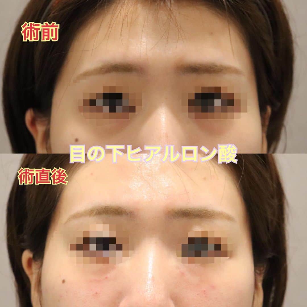 のインスタグラム：「【ヒアルロン酸でアンチエイジング💎】 ・ ・ 年齢とともに、顔のたるみや目元の凹みに お悩みの方も多いのではないでしょうか🥺 ・ ・ お顔の印象を大きく変える目元のクマ🐻 メイクでコンシーラーをたっぷり塗っても 隠しきれないクマもあります。 ・ ・ クマにもいくつか種類があります↓ 【青クマ】血行不良による、青みの強いクマ 【茶クマ】メイクやスキンケアでの摩擦による、色素沈着 【影クマ】たるみにより目元が凹み、影になっているクマ ・ ・ 写真の方は、【影クマ】でお悩みでした😫 ヒアルロン酸を注入して、目元のふっくら感を復活😄❣️ 施術直後で、針跡が残っておりますが、 影になってくすんでいた部分が、ふっくら しているのがお分かりいただけます。 ・ ・ ・ 個人差はありますが、針跡も2.3日〜5日間程度で消え、直後からメイクもOK🙆‍♀️ ・ ・ 半年から1年に一回程度のメンテナンスが オススメです🌟  お気軽にお問い合わせくださいませ(´◡͐`) /////////////////////////////// 【オラクル美容皮膚科】 フリーダイヤル ☎0120-905-696 コールセンター 受付時間 9:00～21:00［年中無休］ LINEからもご予約可能です ID：@oracle.jp //////////////////////////////// . #美容皮膚科 #美容 #美容女子  #美容day #美活 #美肌  #オラクル美容皮膚科 #オラクル  #韓国美容 #キャンペーン  #美白#毛穴#日焼け #シミ #たるみ #ニキビ #痩身  #ピーリング #レーザー #beauty #ボトックス#ヒアルロン酸#アンチエイジング#シワ#保湿#乾燥」