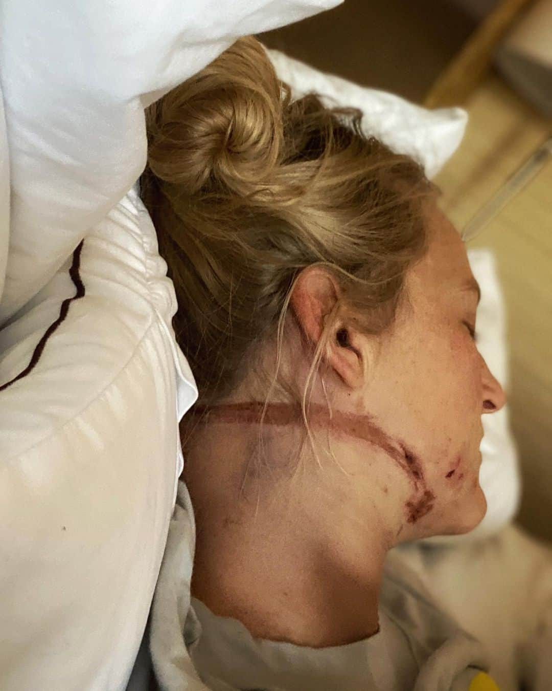 エミリー・ハリントンさんのインスタグラム写真 - (エミリー・ハリントンInstagram)「I had an accident yesterday on El Cap. I’m banged up but gonna be ok thankfully.  Not much to say except I took a bad fall and pin balled a bit then somehow hit the rope w my neck - 🤷🏼‍♀️🤦🏼‍♀️ All I know is that I am extremely grateful to have had @adrianballinger @alexhonnold @jonglassberg @sannimccandless @tarakerzhner and YOSAR of course there to get me out and help me through ❤️ // thanks everyone who sent kind messages and thoughts - feeling so supported and loved 💕 // 📸 portrait by @tarakerzhner + neck selfie」11月26日 3時53分 - emilyaharrington