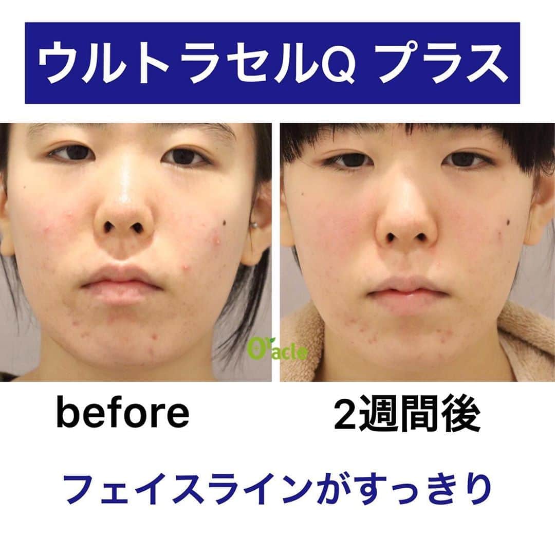 のインスタグラム：「【経過】ウルトラセルQプラス⤴️﻿ #医療用ハイフ #hifu﻿ ﻿ 2週間後の経過です⤴️﻿ フェイスラインがすっきりされていますね👍﻿ ﻿ ウルトラセルQプラスは﻿ 直後と1ヶ月後位が効果のピークになります⤴️﻿ ﻿ 現在、オラクルで大人気となっております⤴️⤴️⤴️﻿ ﻿ 11月半額キャンペーン﻿ 残りわずか…﻿ ﻿ 【11月限定】﻿ 💵全顔＋顎下 60,000円（税抜）﻿ ※通常12万円﻿ ﻿ ▪️▫️▪️▫️▪️▫️▪️▫️▪️▫️﻿ ﻿ ウルトラセルQプラスは…﻿ 進化版医療用ハイフ‼️﻿ ﻿ 痛みなし、ダウンタイムなしで﻿ ﻿ ⇧ ほうれい線﻿ ⇧ 目の周りのシワ﻿ ⇧ 額のシワ﻿ ⇧ 二重アゴ﻿ ⇧ ハリアップ ﻿ ﻿ に効果があります⤴️﻿ ﻿ さらにコラーゲンがつくられお肌の艶、ハリもアップ☝️﻿ ﻿ 施術間隔は3ヶ月に1回がベスト‼️﻿ ﻿ 今年の年末はきゅっと引き締まったフェイスラインで👱🏻‍♀️﻿ ﻿ ▪️▫️▪️▫️▪️▫️▪️▫️▪️▫️﻿ ﻿ 【リスクなど】﻿ 治療後の赤みが出た場合でも当日中にほぼ治ります。﻿ 腫れもほとんどありませんが、稀に腫れが残る方もいますが、大半の場合２～３日以内に落ち着きます。﻿ ※個人差があります。﻿ ﻿ たるみ予防にもかなりおすすめです⤴︎﻿ ﻿ ▪️▫️▪️▫️▪️▫️▪️▫️▪️▫️﻿ ﻿ 🇯🇵オラクル美容皮膚科🇰🇷﻿ 📍新宿3丁目19-4 MLJ新宿8階﻿ ﻿ 【専門】﻿ ニキビ（跡）／毛穴／シミ／しわ／たるみ／痩身／アンチエイジング／美白美肌治療全般／ブライダル相談﻿ ﻿ 🗝完全予約制﻿ 👠土日祝日も診療﻿ ﻿ 【予約方法】﻿ ☎0120-905-696﻿ ⏰9:00～21:00［年中無休］﻿ ﻿ LINE、メール24時間📧﻿ LINE🆔 @oracle.jp ﻿ 📩HPメールフォームよりお願いいたします﻿ ﻿ ﻿ ▪️▫️▪️▫️▪️▫️▪️▫️▪️▫️﻿ ﻿ #オラクル美容皮膚科 #オラクル ﻿ #oracle #韓国美容 #美容皮膚科 ﻿ #たるみ #ウルセラ #リフトアップ ﻿ #小顔 #アンチエイジング #イントラジェン #女医  #ほうれい線﻿ #切らないたるみ治療 #皮膚科 #美容  #小顔矯正 #コラーゲン #ウルトラセル #ウルトラセルQプラス #オラクルウルトラセル  #医療用ハイフ #美容オタク #美容マニア」