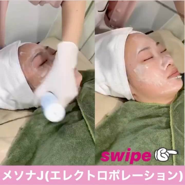 のインスタグラム：「11月は白玉点滴プレゼント🎁💕﻿ 今まで導入できなかった美容成分を大量導入💎﻿ ﻿ 直後から変化を実感して頂けます💖﻿ ﻿ ﻿ メソナJ(エレクトロポレーション)は﻿ お悩み別でコースが選べる😊﻿ ﻿ ﻿ ----11月限定----﻿ 💎赤ら顔改善コース＋白玉点滴⇒￥14,400﻿ 💎美白肌コース＋白玉点滴⇒￥20,800﻿ 💎ニキビ撃退コース⇒￥20,000円﻿ 💎トータルアンチエイジングコース⇒￥24,000﻿ ※全てトライアル料金﻿ ※料金は全て税抜価格です。﻿ ﻿  #オラクル美容皮膚科 #オラクル #oracle #美容皮膚科 #メソナj #エレクトロポレーション #美肌 #美肌ケア #美肌になりたい #美白ケア #美白効果 #美白 #ニキビ #ニキビケア #アンチエイジング #アンチエイジング効果 #美容 #美容部 #美容好き #美容好きな人と繋がりたい #美容オタク #美容オタクさんと繋がりたい #韓国美容 #韓国 #🇰🇷 #新宿 #新宿東口 #」