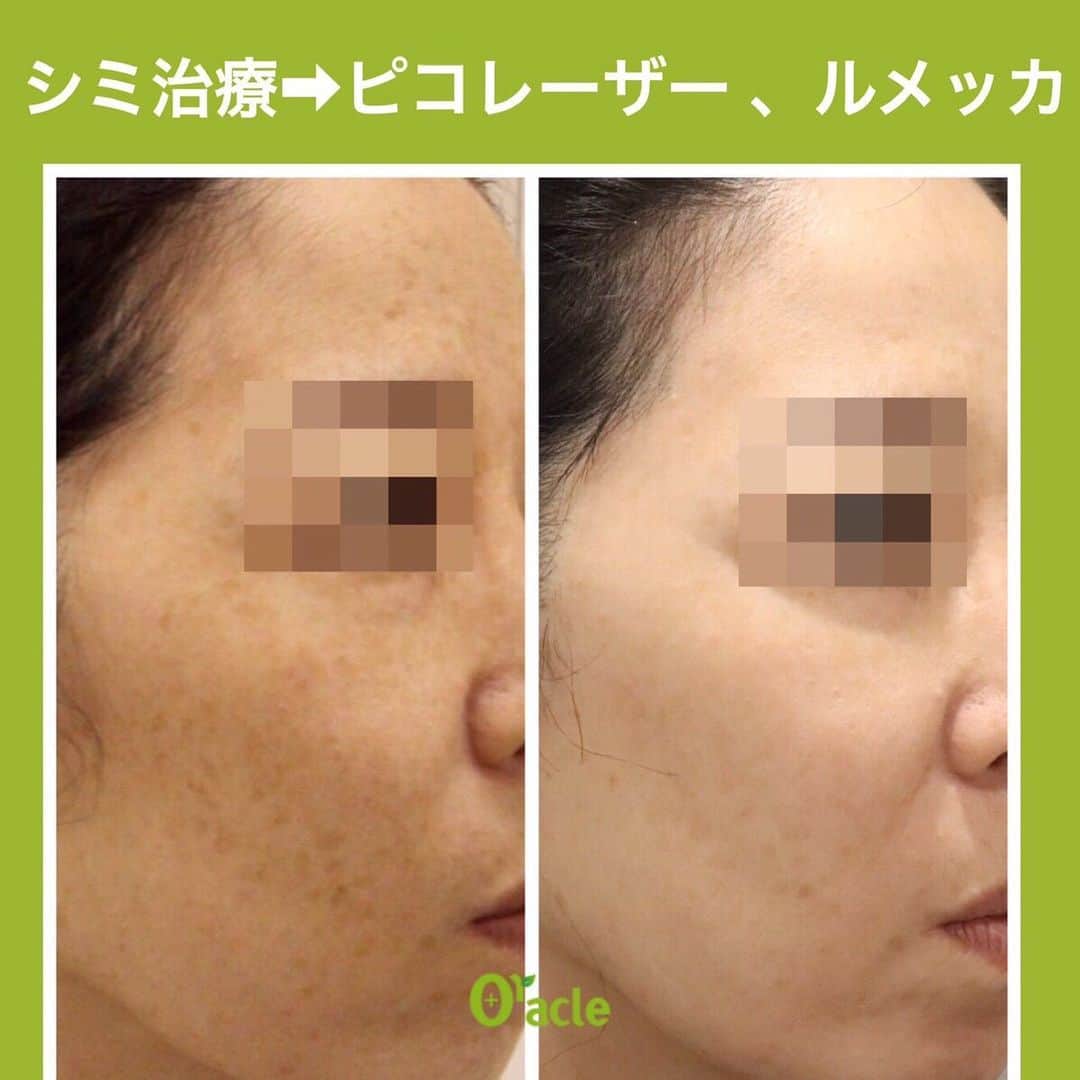 のインスタグラム：「12月も継続決定！！🌟﻿ シミ・肝斑・そばかす治療を応援💪﻿ ﻿ 【治療経過】﻿ ☆ピコトーニング　5回﻿ ﻿ ☆ルメッカ　5回﻿ ﻿ ⇨頬のシミはかなり綺麗に改善。﻿ 目の周りのシミも薄くなっています。﻿ ﻿ ピコトーニング・ルメッカはシミ治療だけではなく、﻿ くすみをとってお肌全体を明るく整え艶を出す効果もあり、﻿ お顔全体が明るく綺麗になりました。﻿ ﻿ ﻿ -----12月イベント-----﻿ シミ・肝斑にお悩みの方﻿ 💎ピコトーニング(初回) ￥29,800﻿ ﻿ シミ・そばかすにお悩みの方﻿ 💎ルメッカ(初回)﻿ 部分(頬上or下部) ￥18,000﻿ 全顔 ￥25,000﻿ ﻿ ﻿ ⚠️リスクなど⚠️﻿ 一時的にシミが濃くなる、数日瘡蓋、赤みやほてり感、乾燥など﻿ ﻿ ▪️▫️▪️▫️▪️▫️▪️▫️▪️▫️﻿ ﻿ シミ、赤ら顔、そばかすなどのご相談はお気軽にお問い合わせください。﻿ まずはカウンセリングだけでも🆗👌﻿ ﻿ ▪️▫️▪️▫️▪️▫️▪️▫️▪️▫️﻿ ﻿ 🇯🇵オラクル美容皮膚科🇰🇷﻿ 📍新宿3丁目19-4 MLJ新宿8階﻿ ﻿ 【専門】﻿ ニキビ（跡）／毛穴／シミ／しわ／たるみ／痩身／アンチエイジング／美白美肌全般／ブライダル相談﻿ ﻿ 🗝完全予約制﻿ 👠土日祝日も診療﻿ ﻿ 【予約方法】﻿ ☎0120-905-696﻿ ⏰9:00～21:00［年中無休］﻿ ﻿ LINE、メール24時間📧﻿ LINE🆔 @oracle.jp ﻿ 📩HPメールフォームよりお願いいたします﻿ ﻿ ﻿ #オラクル美容皮膚科 #オラクル #oracle #シミ #肝斑 #そばかす #シミ取り #シミケア #シミ対策 #美肌 #美肌ケア #美肌作り #美肌になりたい #美肌効果 #美白ケア #美白効果 #トーンアップ #たるみ #たるみ改善 #美容皮膚科 #美容 #美容好き #美容部 #美容好きな人と繋がりたい #美容好き #韓国美容 #韓国 #イベント #🇰🇷 #美容オタク」