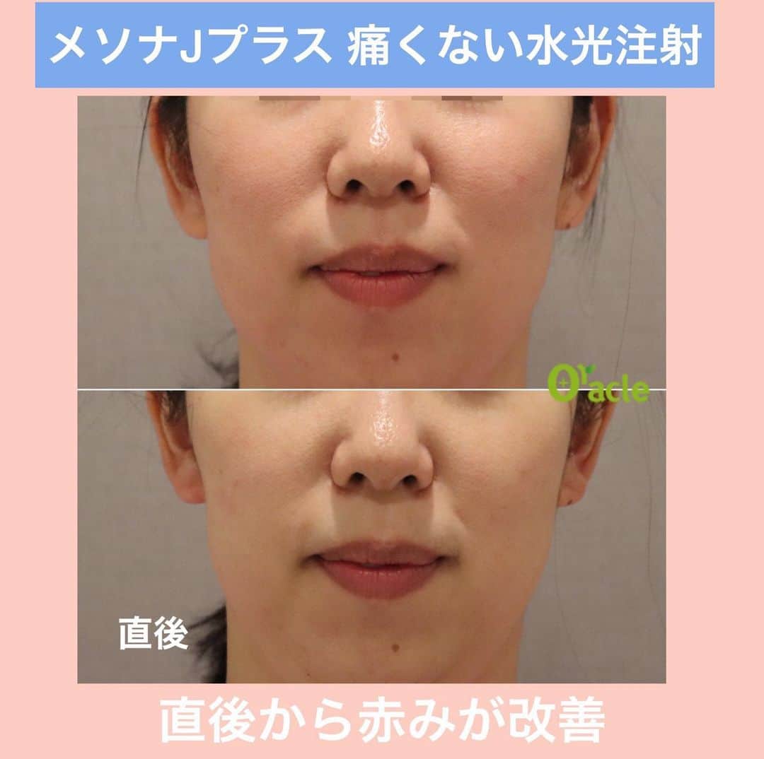 オラクル美容皮膚科東京新宿院さんのインスタグラム写真 - (オラクル美容皮膚科東京新宿院Instagram)「空気の乾燥🗯 髪の静電気🗯﻿ ﻿ そして…﻿ お肌の乾燥の季節になりました💨﻿ ﻿ 本日の東京 うるおい指数➡︎50﻿ 肌荒れ注意報です😱﻿ ﻿ ▪️▫️▪️▫️▪️▫️▪️▫️▪️▫️﻿ ﻿ お肌を美しく整える基本は「保湿」💦💧💦﻿ ﻿ 保湿が不足していると様々なお肌のトラブルを引き起こしたり😱﻿ ﻿ エイジングを加速させてしまう原因となります😱﻿ ﻿ 冬は空気の乾燥で身体全体が乾燥しますので念入りに保湿を心がけてください💦💧💦﻿ ﻿ 保湿をしっかりするだけでもお肌は変わります😊﻿ ﻿ ▪️▫️▪️▫️▪️▫️▪️▫️▪️▫️﻿ ﻿ そして…﻿ 日常のスキンケアに加えていただきたいのがクリニックでの保湿ケア💦💧💦﻿ ﻿ スキンケアでしっかり保湿していてもお肌の深層部まで届けるのはやはり難しい🤔﻿ ﻿ ﻿ 私たちスタッフも医療での保湿ケアを続けることによるお肌の変化、大切さを日々感じております。﻿ ﻿ ▪️▫️▪️▫️▪️▫️▪️▫️▪️▫️﻿ ﻿ どんな保湿ケアがいいのか⁈🤔﻿ ﻿ どの施術が自分に合っているのか分からない🤔﻿ ﻿ という方はたくさんいらっしゃいますので、まずは相談だけでも大丈夫です🙆‍♀️﻿ ﻿ ▪️▫️▪️▫️▪️▫️▪️▫️▪️▫️﻿ ﻿ 【おすすめ】﻿ ダウンタイムもなく保湿効果がとても高く﻿ 今、古市院長やオラクルスタッフがおすすめするのがお肌に大量の美容成分を送り込むことができる最新の浸透美容﻿ ﻿ 💎メソナJ💎﻿ ﻿ 💎メソナJプラス💎﻿ ﻿ トライアル料金もございますので﻿ この冬ぜひ保湿対策に取り入れてみませんか！？﻿ ﻿ ﻿ 【保湿におすすめ】﻿ メソナJプラス　トライアル﻿ 💎保湿コース 30,000円﻿ 💎美白（トラネキサム酸）35,000円﻿ ﻿ メソナJ  トライアル﻿ 💎美白肌  20,800円﻿ 💎トータルアンチエイジング 24,000円﻿ ﻿ ▪️▫️▪️▫️▪️▫️▪️▫️▪️▫️﻿ ﻿ ⚠️リスクなど⚠️﻿ ・施術中に軽いピリピリ感を感じる場合があります。﻿ ﻿ ・電気による刺激やスティックによる摩擦での発疹、施術部位の赤み、かさつきなどが稀に起こる場合があります。﻿ ﻿ ▪️▫️▪️▫️▪️▫️▪️▫️▪️▫️﻿ ﻿ コースはご来院後に決めていただいで大丈夫です🙆‍♀️﻿ ﻿ ご予約お待ちしております📲﻿ ﻿ ▪️▫️▪️▫️▪️▫️▪️▫️▪️▫️﻿ ﻿ 🇯🇵オラクル美容皮膚科🇰🇷﻿ 📍新宿3丁目19-4 MLJ新宿8階﻿ ﻿ 【専門】﻿ ニキビ（跡）／毛穴／シミ／しわ／たるみ／痩身／アンチエイジング／美白美肌治療全般／ブライダル相談﻿ ﻿ 🗝完全予約制﻿ 👠土日祝日も診療﻿ ﻿ 【予約方法】﻿ ☎0120-905-696﻿ ⏰9:00～21:00［年中無休］﻿ ﻿ LINE、メール24時間📧﻿ LINE🆔 @oracle.jp ﻿ 📩HPメールフォームよりお願いいたします﻿ ﻿ ▪️▫️▪️▫️▪️▫️▪️▫️▪️▫️﻿ ﻿ #エレクトロポレーション  #美肌 #美白 #ハリ  #リジュラン #幹細胞 #BNLS #水光注射 #最新美容 #メソナＪ #リジュラン #ボトックス #BNLS﻿ #美容 #美容皮膚科  #イオン導入 #ヒト幹細胞 #サーモン注射 # ノーニードル注射  #アンチエイジング #若返り #毛穴  #脂肪溶解 #顔痩せ #美白ケア #美容オタク #美容マニア #美容マニア御用達 #美容好きな人と繋がりたい #美容好き #美容好きさんと繋がりたい」11月30日 9時27分 - oraclejp