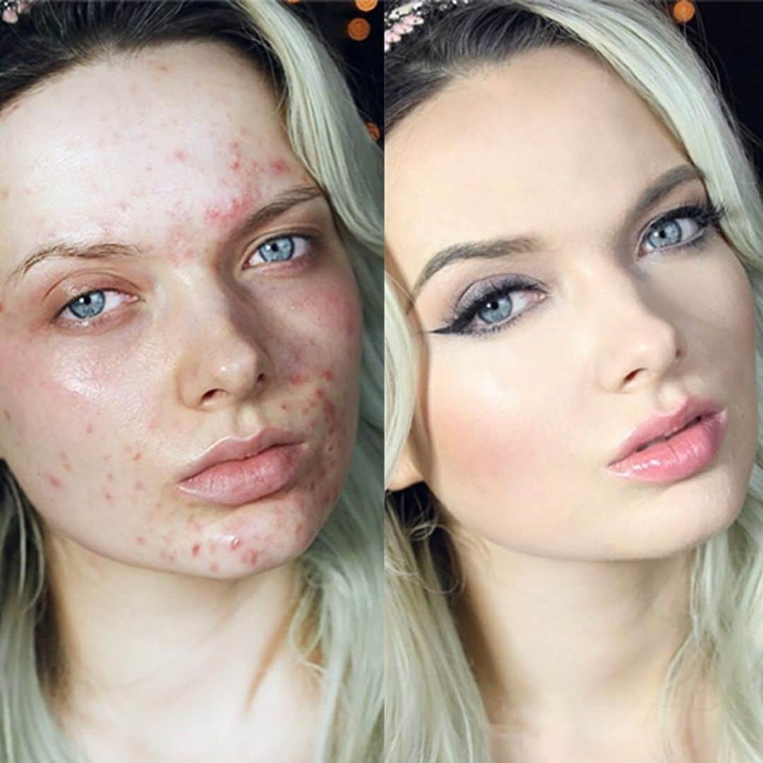 エム・フォードのインスタグラム：「Imagine going to school for 10 years to become a plastic surgeon... and then having to steal peoples photographs to try and make ££££ by promoting an ‘acne cure’ with those stolen photographs..... @giacomourtis @drurtismedicalcosmetics you’re a DOCTOR for Christ’s sake 😳. Stop being a FRAUD, misleading your patients.... and  stealing my images to promote your quackery. It’s disgusting, shameful and I’m pretty sure it goes against medical ethics too. Your patients deserve better, people with acne deserve better - and quite frankly, I deserve better too. I don’t know you, I’ve never met you, and I’ve never heard of you or your ‘acne system before... so please do explain how you justify this? In case you didn’t know... i’m an actual person, with actual feelings, and that’s my actual face. I’m not just some marketing image that you can google and steal without consequences. I’m a human being, and i’m tired of people like you using my face to tell others that we are disgusting, or we need to sign up to some bullshit program to be beautiful. Newsflash 💥 - WE DON’T ❗️. We just want to be accepted, the way we are, and for who we are. It’s really not difficult to be an honest, kind and respectful  person... and as a DOCTOR - you should know better... Christ.  As a someone with acne, on behalf of everyone with acne - I look forward to my lawyers & team sending you the bill for unauthorised use of my image. Ps. It costs nothing to be a good person, shame you didn’t realise that before.  #redefinepretty #skinpositivity #acnepositivity」