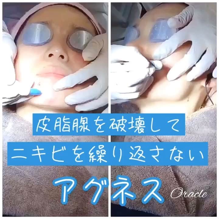 のインスタグラム：「本格ニキビ治療【アグネス】⚡️﻿ ﻿ 初回限定 18,000円（税抜）﻿ 片側:顎、頬、こめかみ、1箇所:鼻﻿ ※麻酔代別﻿ ﻿ アグネスのすごいところ！！﻿ 👉選択的皮脂腺の破壊⚡️﻿ ＝ニキビをピンポイントで壊す⚡️﻿ ﻿ だから根本的改善が期待できる﻿ ﻿ 🔳長年ニキビで悩んでいる﻿ 🔳炎症ニキビ﻿ 🔳白ニキビ、黒ニキビ﻿ ﻿ もうニキビ繰り返したくない⚡️﻿ ﻿ オラクルの本格ニキビ治療がおすすめです↗️﻿ ﻿ オラクルではニキビ治療を専門的に行っております。﻿ ﻿ 痛みが苦手、レーザー治療はまだ抵抗があるという方には﻿ ニキビ専用のピーリング治療、内服、点滴などのメニューもございます。﻿ ﻿ まずはお気軽にご相談ください。﻿ ﻿ ▪️▫️▪️▫️▪️▫️▪️▫️▪️▫﻿ ﻿ 💐年末年始のお知らせ💐﻿ 12月31日〜1月3日まで休診﻿ 📲予約受付は年中無休﻿ （電話、メール、LINE）﻿ ﻿ ▪️▫️▪️▫️▪️▫️▪️▫️▪️▫️﻿ ﻿ 🇯🇵オラクル美容皮膚科🇰🇷﻿ 📍新宿3丁目19-4 MLJ新宿8階﻿ ﻿ 【専門】﻿ ニキビ（跡）／毛穴／シミ／しわ／たるみ／痩身／アンチエイジング／美白美肌全般／ブライダル相談﻿ ﻿ 🗝完全予約制﻿ 👠土日祝日も診療﻿ ﻿ 【予約方法】﻿ ☎0120-905-696﻿ ⏰9:00～21:00［年中無休］﻿ ﻿ LINE、メール24時間📧﻿ LINE🆔 @oracle.jp ﻿ 📩HPメールフォームよりお願いいたします﻿ ﻿ ▪️▫️▪️▫️▪️▫️▪️▫️▪️▫️﻿ #オラクル美容皮膚科 #オラクル ﻿ #oracle #美容皮膚科 ﻿ #メディカルエステ #皮膚管理 ﻿ #ニキビ #ニキビ跡 #ニキビ治療 #アグネス #ニキビケア #ニキビ跡ケア #ニキビ肌 #ニキビ改善 #ニキビ専門 #ニキビ皮膚科」
