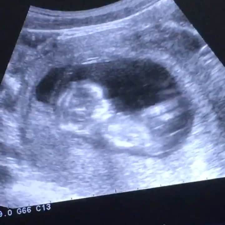 しほの涼のインスタグラム：「去年の今頃。 2cmの娘ちゃん👶🌼🌼 絶賛入院中で3日に1回のエコーだけが、生き甲斐でした。 足を蹴り蹴り、とっても元気😌 赤ちゃん元気だから頑張ろうって思えたなぁ。今は68cm身長あるよ笑 #エコー動画 #エコー写真 #11w5d #11w5dpregnant #第一子#お腹の中で大暴れ #妊婦#胎児#胎動#重度妊娠悪阻#悪阻#つわり#エコー#妊娠3ヵ月#令和ベイビー#生命の神秘」