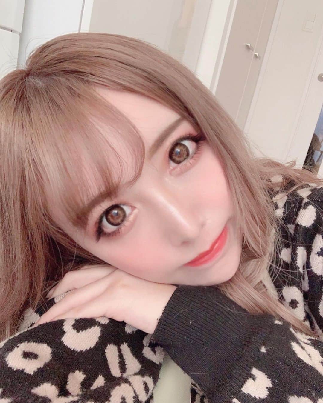 のインスタグラム：「こんにちわ🙈🌟 . 年越す前に👁目の下のクマの治療💕 をしにプルージュ美容クリニック🏥に行ってPRP治療してきたよ💉🌟 @pruge_clinic .  PRPとは自分の血液を使った再生医療💊なのだ✨自分の血液だから安心🥺🙏 私は目の下のクマはくぼみがあったのでPRPを打ってボリュームアップしてもらいました🙈💕 術後すぐは少し腫れたけど、どんどん馴染んで悩みだった目の下のクマが改善されてびっくりした🥺❤️❤️ しかもPRPは美肌効果もあるので目の下乾燥しやすくて化粧ヨレ😨激しかったけどそれも改善されたー🙌💗💗 . おデコにも注入できるらしくて おデコ入れてる友達いるけどめっちゃふっくらしてました🙆‍♀️🌟 . 特に目の下は本当に良かった～🐭💗 目の下のクマ悩んでる人お勧め😍❤️ . #プルージュ美容クリニック #ぷるぷる注射」