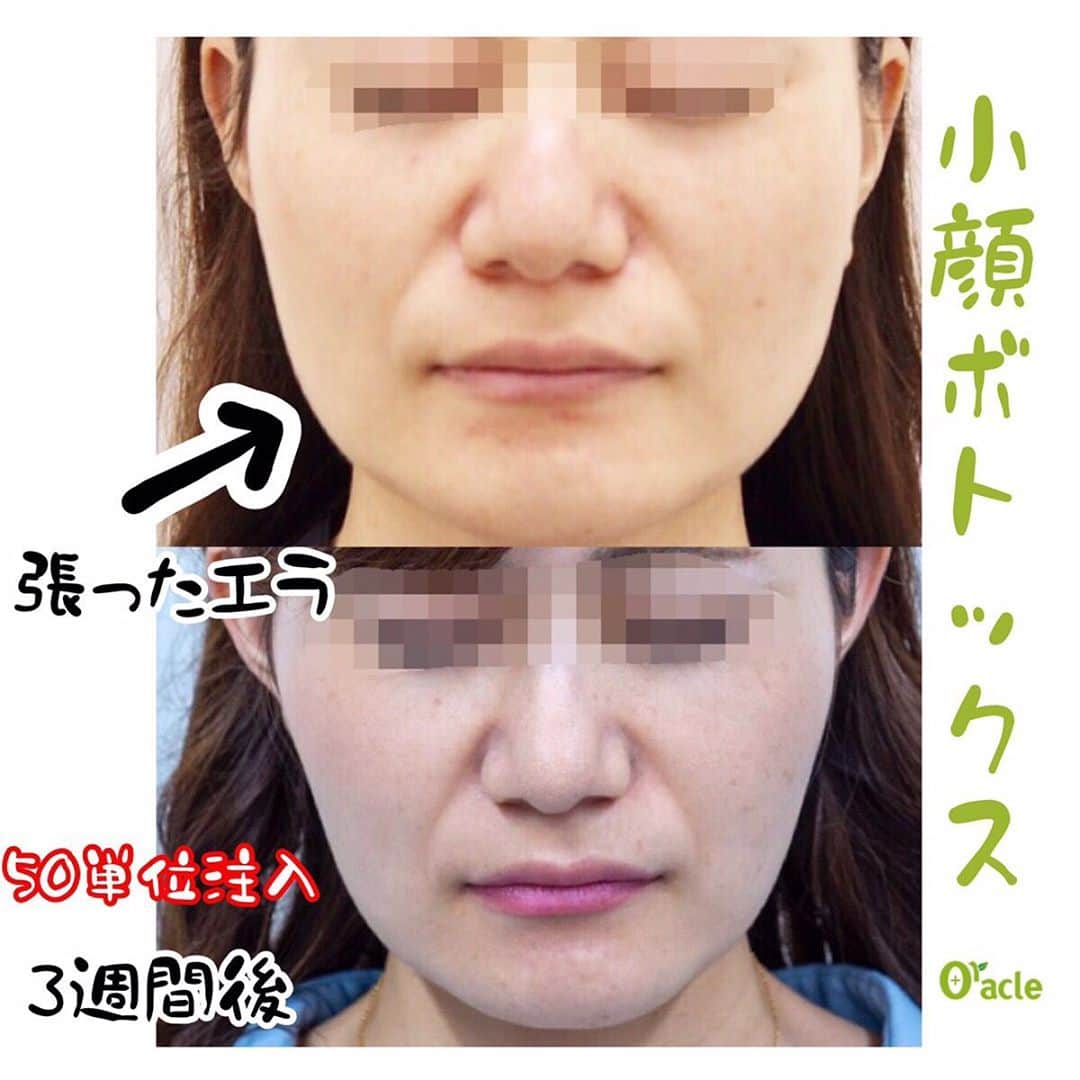 オラクル美容皮膚科東京新宿院さんのインスタグラム写真 - (オラクル美容皮膚科東京新宿院Instagram)「小顔の大敵『歯のくいしばり』⚡﻿ ﻿ エラボトックスで小顔に😍﻿ ﻿ ﻿ 【料金】﻿ ♡リジェノックス(10単位)　￥5,000(税抜)﻿ ♡アラガン(10単位) ￥7,000(税抜)﻿ ﻿ 写真の患者様は50単位で治療されました。﻿ ﻿ ﻿ ▪️▫️▪️▫️▪️▫️▪️▫️▪️▫️﻿ ﻿ ﻿ ▽こんなお悩みの方におススメ🕊﻿ ・歯ぎしりをしてしまう﻿ ・エラが張り顔が大きく見えてしまう﻿ ・いつの間にか歯が欠けてしまっている﻿ ・骨を削らずに小顔になりたい﻿ ・無意識にくいしばっている﻿ ﻿ ﻿ ▪️▫️▪️▫️▪️▫️▪️▫️▪️▫️﻿ ﻿ ﻿ ボトックスの施術は約5分。﻿ 効果は約3～4か月ほど持続します😊﻿ ﻿ ﻿ ▪️▫️▪️▫️▪️▫️▪️▫️▪️▫️﻿ ﻿ ﻿ 🌈年末年始のお知らせ🌈﻿ 12月31日〜1月3日まで休診﻿ 📲予約受付は年中無休﻿ (電話、メール、LINE)﻿ ﻿ ﻿ ▪️▫️▪️▫️▪️▫️▪️▫️▪️▫﻿ ﻿ 🇯🇵オラクル美容皮膚科🇰🇷﻿ 📍新宿3丁目19-4 MLJ新宿8階﻿ ﻿ 【専門】﻿ ニキビ（跡）／毛穴／シミ／しわ／たるみ／痩身／アンチエイジング／美白美肌治療全般／ブライダル相談﻿ ﻿ 🗝完全予約制﻿ 👠土日祝日も診療﻿ ﻿ 【予約方法】﻿ ☎0120-905-696﻿ ⏰9:00～21:00［年中無休］﻿ ﻿ LINE、メール24時間📧﻿ LINE🆔 @oracle.jp ﻿ 📩HPメールフォームよりお願いいたします﻿ ﻿ ▪️▫️▪️▫️▪️▫️▪️▫️▪️▫️﻿ ﻿ #オラクル美容皮膚科 #オラクル #oracle #美容皮膚科 #エラボトックス #エラ #ボトックス #小顔 #小顔整形 #小顔効果 #小顔になりたい #美肌 #美肌ケア #美肌レシピ #美白 #美白ケア #美白効果 #美容 #美容好き #美容好きな人と繋がりたい #美容好きさんと繋がりたい #美容好きと繋がりたい #美容オタク #美容オタクさんと繋がりたい #美容部 #美容男子 #美容垢 #韓国美容 #韓国 #韓国好きな人と繋がりたい」12月16日 18時03分 - oraclejp
