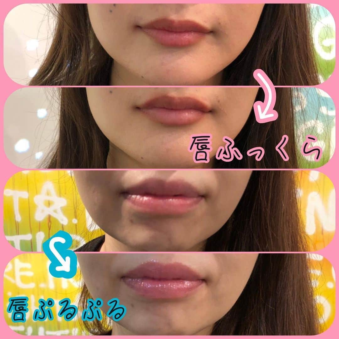 オラクル美容皮膚科東京新宿院さんのインスタグラム写真 - (オラクル美容皮膚科東京新宿院Instagram)「#最新 #リップケア﻿ パークリップ💋﻿ ﻿ 先日、イベントで体験いただいた﻿ ハイドラフェィシャル パークリップ💋﻿ を改めてご紹介❣️﻿ ﻿ パークリップは専用の美容液を使って、ハイドラフェィシャルの機械で唇をケアします。﻿ ﻿ 施術した途端にぷっくりして唇の色が明るく変わってきます😍﻿ ﻿ なぜそんなにすぐに変わるの⁈🤔﻿ ﻿ この美容液はペパーミントオイルや芍薬エキスなどが主成分で、唇をふっくらとさせハリと潤いを与えてくれる効果があります☝️﻿ そして特殊な技術で唇に美容液を入れていくことで﻿ ↓↓↓﻿ ﻿ 💋ヒアルロン酸並みの唇ぷっくり効果﻿ 💋唇の縦じわを改善﻿ 💋くすみが取れて唇の血色が良くなる﻿ 💋保湿効果﻿ ﻿ などの効果が期待できます。﻿ ﻿ ダウンタイムもないので﻿ 特別な日の前にもおすすめです💋﻿ ﻿ 【料金】﻿ パークリップ 1回 8,000円（税抜）﻿ 美容液のみの購入 1本 4,800円（税抜）﻿ ﻿ 【お知らせ】﻿ 🎄クリスマス限定🎅﻿ 12月23、24、25日は﻿ ハイドラフェイシャル﻿ 全員対象19,000円(税抜)﻿ ﻿ さらに1日5名様にパークリップ美容液プレゼント🎁﻿ ﻿ ▪️▫️▪️▫️▪️▫️▪️▫️▪️▫﻿ ﻿ 💐年末年始のお知らせ💐﻿ 12月31日〜1月3日まで休診﻿ 📲予約受付は年中無休﻿ （電話、メール、LINE）﻿ ﻿ ▪️▫️▪️▫️▪️▫️▪️▫️▪️▫﻿ ﻿ 🇯🇵オラクル美容皮膚科🇰🇷﻿ 📍新宿3丁目19-4 MLJ新宿8階﻿ ﻿ 【専門】﻿ ニキビ（跡）／毛穴／シミ／しわ／たるみ／痩身／アンチエイジング／美白美肌治療全般／ブライダル相談﻿ ﻿ 🗝完全予約制﻿ 👠土日祝日も診療﻿ ﻿ 【予約方法】﻿ ☎0120-905-696﻿ ⏰9:00～21:00［年中無休］﻿ ﻿ LINE、メール24時間📧﻿ LINE🆔 @oracle.jp ﻿ 📩HPメールフォームよりお願いいたします﻿ ﻿ ▪️▫️▪️▫️▪️▫️▪️▫️▪️▫️﻿ ﻿ #美容 #美容皮膚科 ﻿ #オラクル美容皮膚科 #오라클피부과 ﻿ #ハイドラ #韓国美容﻿ #角質除去 #タンパク質汚れ #HYDRAFACIAL #リップケア﻿ #韓国  #ヒアルロン酸 #スマイルリップ #美肌 #ピーリング #毛穴 #保湿  #角質 #ハイドラフェイシャル #唇ぷるぷる﻿  #オラクルハイドラフェィシャル﻿ #韓国好きな人と繋がりたい ﻿ #韓国美容皮膚科 ﻿ #韓国好きな人と仲良くなりたい﻿」12月20日 9時08分 - oraclejp