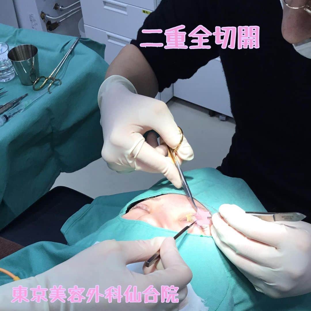 東京美容外科公式さんのインスタグラム写真 - (東京美容外科公式Instagram)「🎂東京美容外科 仙台院です🎂 ・ 二重全切開の手術風景です🙌 切開法は二重のラインを切開することで理想の二重ラインをデザインする施術です😘 同時に目の上の余分な脂肪や皮膚を切除するのでスッキリとした二重にできます🌸 . リスクと術後の注意点☝︎ 埋没法と比べるとダウンタイムは長くなりますが目立たない腫れは1〜2週間かけ徐々に引いていきますのでご安心ください💡 完全に腫れが引くまでには半年程度かかりますがお化粧していただければ普段の生活に差し支えありません😊 お化粧は5日〜1週間後の抜糸翌日から可能です✨ ・ まずは、ご気軽にカウンセリングしませんか？ スタッフ一同ご連絡お待ちしております🙌 ・ 🌷アクネ水光注射（初回） ¥19,000 . 🌷リジュランヒーラー水光注射（初回） ¥30,000 ・ ☘ミラドライ (片ワキ1回) ¥150,000 ☘️ミラドライ（両ワキ1回） ¥250,000 ☘️ミラドライ（両ワキ1回） 保証1回（1年間有効） ¥400,000 . その他メニュー各種ございます😊💕 お気軽にお問い合わせくださいませ🍏🍎 各線「仙台駅」より徒歩5分、JR仙石線「あおば通駅」より徒歩2分 ♡ 東京美容外科 仙台院にぜひお越しください！😇 . . ====🎁お問い合わせはこちら🎁==== 詳しくはプロフィールのURLから公式サイトへ♪ ▼フリーダイヤル 0120-658-958 （コールセンター受付時間：9：00～21：00） ▼LINE予約 @ tkc110 ========================= . #東京美容外科 #東京美容外科仙台院 #仙台 #宮城 #美容 #美容整形 #きれい #整形 #美活 #綺麗になりたい #美肌 #美意識  #美容外科 #プチ整形 #韓国  #エイジングケア #アンチエイジング #美容好き #韓国美容 #美容整形外科 #二重切開経過 #二重全切開 #二重 #二重切開 #二重全切開経過 #二重埋没  #アイプチ」12月20日 18時08分 - tokyobiyougeka_jimukyoku