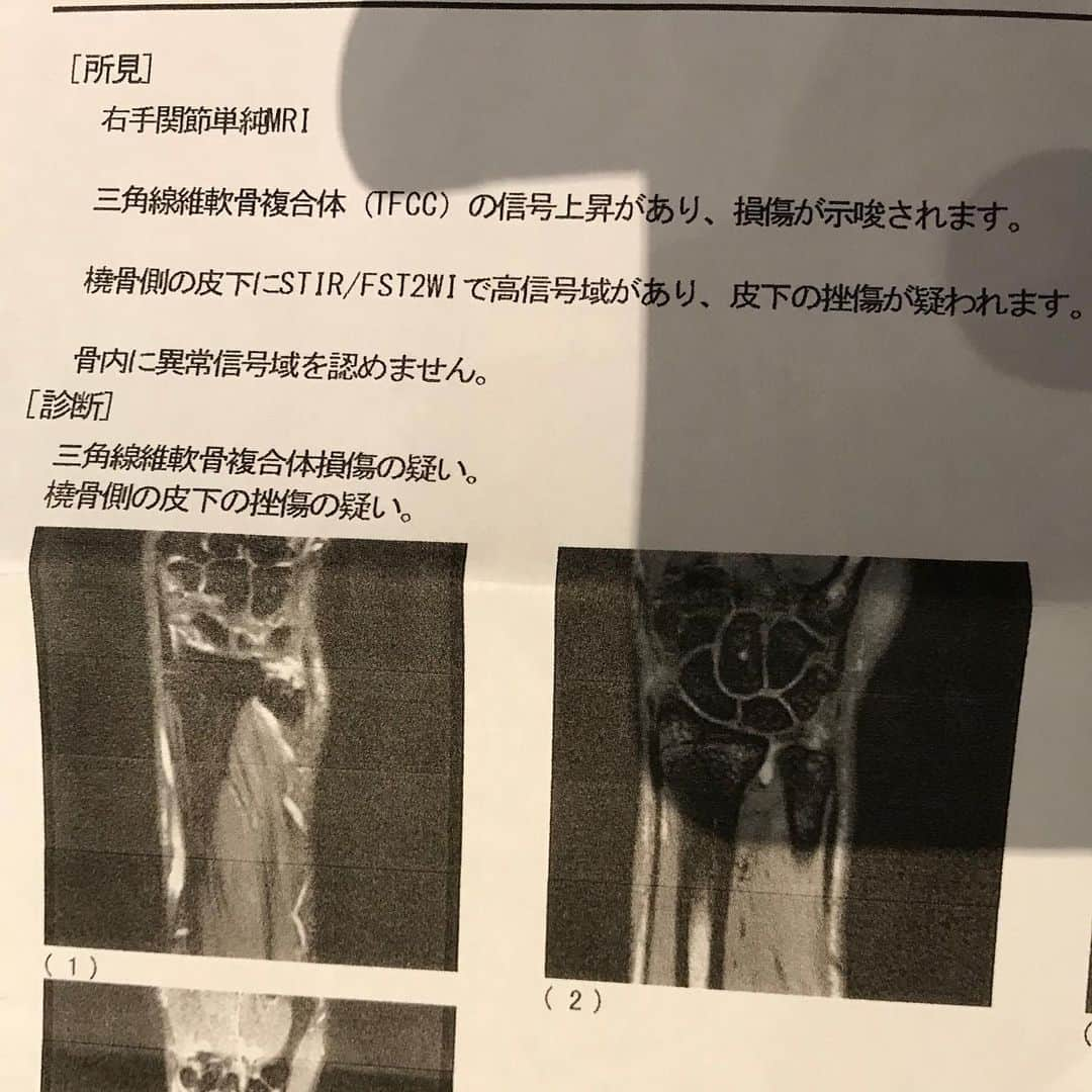 赤平大さんのインスタグラム写真 - (赤平大Instagram)「右手首の精密検査（MRI）で「TFCCの損傷＝靭帯損傷」と判明。有村智恵さんが苦しみ、武蔵丸の引退要因と同じ。 3〜4ヶ月で痛みが変わらなければ、手術。おおおぉぅ… ドクターストップでジム活動自粛。筋肉落ちる。おおおおおうぅぅぅ… 健康と若さを欲しがった厄男（本厄）が、筋トレしただけなのに…  #tfcc損傷 #靭帯損傷 #有村智恵 #武蔵丸 #手術 #慢心して #ゴルフ の #打ちっぱなし #キャッチボール #遠投 #をした今週の自分を #ぶっ飛ばしたい」12月24日 16時32分 - masaru_akahira