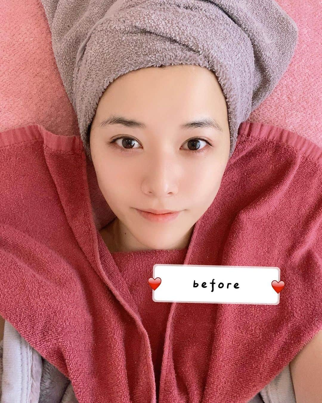 望月海羽さんのインスタグラム写真 - (望月海羽Instagram)「お顔スッキリ✨ しっとりもちもち🥰 ・ BeautySalon LeLienさんへ〜🎶 幹細胞付 HIFU美小顔ダブルでお肌リフトアップ&おめめぱっちりに😳💕 ビフォーアフター見て〜😆🎶 ・ まず最初に高濃度の幹細胞3種類配合されたクレンジングを使ってくれていて りんご幹細胞は腐らないりんごを使用🍎3ヶ月放置してもそのまま美味しく食べられるりんごで酸化しないお肌作り♪ ぶどう幹細胞は日焼けしたお肌の沈静化にもいいらしい🍇 アルガンツリーの幹細胞は高保湿でお肌を潤してくれるんだって♪7年間水がなくても枯れないと言われているアルガンツリー🌿の葉っぱの先や根の先にあるぐんぐん成長する幹細胞を使って傷んだお肌を整えてくれる😊✨ ・ HIFUはたるんだまぶたやほうれい線に✨ 骨格に合わせて当て方も調整してくれるので左右のバランスや歪みが整った気が☺️ ・ 〆のローションはブルカリアローズ水とバラプラセンタ配合でとってもいい香りでリラックス出来ました🌹 クリームとか塗らなくてもしっとりもちもちです〜🥺💕 ・ #望月海羽 #HIFU #幹細胞 #幹細胞コスメ #ビューティーサロンルリアン #赤坂ハイフ #ルリアン赤坂 #pr #コラボベース」12月26日 23時57分 - mikasawada1112