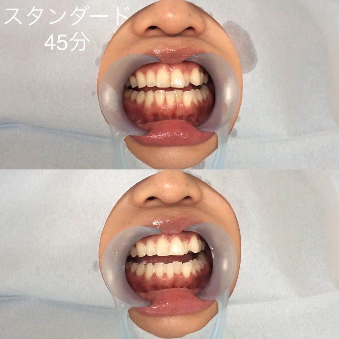ホワイトニング専門クリニック ホワイトラボ東京 渋谷さんのインスタグラム写真 - (ホワイトニング専門クリニック ホワイトラボ東京 渋谷Instagram)「* ⭐️ホワイトニングの頻度について⭐️ こんにちは、ホワイトラボ東京院長のスズキです。 今日はホワイトニングの頻度についてお話していきたいと思います。 * *  最近は「歯の表面の着色を落とす」セルフホワイトニングが多いですね。  こちらは本格的なホワイトニングとは異なるので、  大体の方は２～３回通うとそこで色が止まってしまう様なのですが  タバコを吸う人には人気があるみたいです。 * *  本格的な歯科医院で行うオフィスホワイトニングは当院の場合になりますが  基本的に ◆初めの１～３回で理想的な白さにする。 ◆その後は３～６か月に1回程度色を保つためのメンテナンスを行う。  というくらいの頻度をお勧めしております。 * *  特に歯に影響があるわけではないのですが、たくさんやる意味も逆にはありません。  歯科医師が説明いたしますが、どうしても「何度も何度も通わないといけない！」と勘違いされている人が多いのでお話致しました。 * * ということで遠方の方にもおすすめできますし、  忙しい方も大丈夫です。  何事もやりすぎず、適切な頻度で行うこともよいのかなと思いますよ！  あ、でももちろん自由なのでご自身のペースで来てくださいね。 * * #大晦日まで営業 #ホワイトニング #オフィスホワイトニング #ホワイトニングの頻度 #ホワイトニング歯磨き粉 #ホワイトニング渋谷 #ホワイトニング銀座 #美容 #成人式準備 #前撮り #プレ花嫁 #ブライダルホワイトニング #ブライダルホワイトニングならホワイトラボ東京 #歯を白くする #歯並びを直したい #マウスピース矯正 #ワイヤー矯正 #ビフォーアフター #life #beauty #instabeauty #ホワイトニング人気 #ホワイトニング口コミ」12月29日 20時40分 - whitelabtokyo