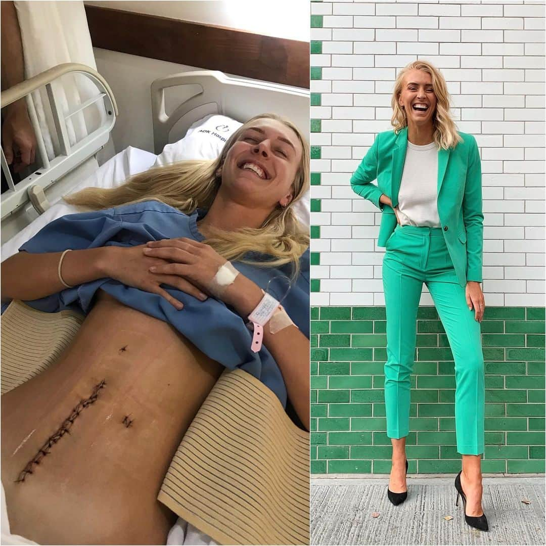 Zanna Van Dijkさんのインスタグラム写真 - (Zanna Van DijkInstagram)「2019. What a year! One full of incredible highs and life threatening lows 💁🏼‍♀️😅 The year didn’t get off to the best start. In January I had emergency bowel surgery in The Maldives, experienced pain like never before, cancelled an 8 week trip of a lifetime with @stephelswood and came home to months of recovery 💉 I have to admit, my health issues did take over my life for a while and as a result I didn’t achieve everything I wanted this year. But I am so glad I focused my energy into my healing. I might not have hit every business target I wanted to, but I rebuilt my body from the ground up and that is one hell of an achievement 🥰🙌🏼 Plus I still managed to do some pretty cool stuff. @staywildswim grew exponentially, became stocked in @theofficialselfridges, exhibited at @londonfashionweek and was featured by @instagram. I came second place as the overall @cosmopolitanuk influencer of the year. I wrote, built and released two ebooks - Eat More Plants and Strong and Sculpted. I hosted a @bbc podcast, was in a global @adidas campaign, headlined @balance_festival, volunteered at @localoceanco and donated well over £5,000 to charity through my business. Plus I reconnected with one of my biggest passions: hiking 🥾⛰ However I also had many meltdowns, stepped away from my main brand partner, received an abundance of online hate and had those I’m close to face their own health issues 💔 It’s safe to say, it’s been a rollercoaster of a year. But it has made me more resilient than ever before. I am ready and excited to grab life with both hands as we enter 2020.  New year, stronger me. Bring it on 👊🏼 #my2019 #2019reflection #newyear #newyears2019 #newyears #2019goals #thecanaryislands 2019journey #beforeandafter #transformationtuesday #emergencysurgery #cecalvolulus #twistedbowel #newyearnewme #surgeryrecovery #blogger #londonblogger #strongwoman #strongereveryday」12月30日 23時31分 - zannavandijk