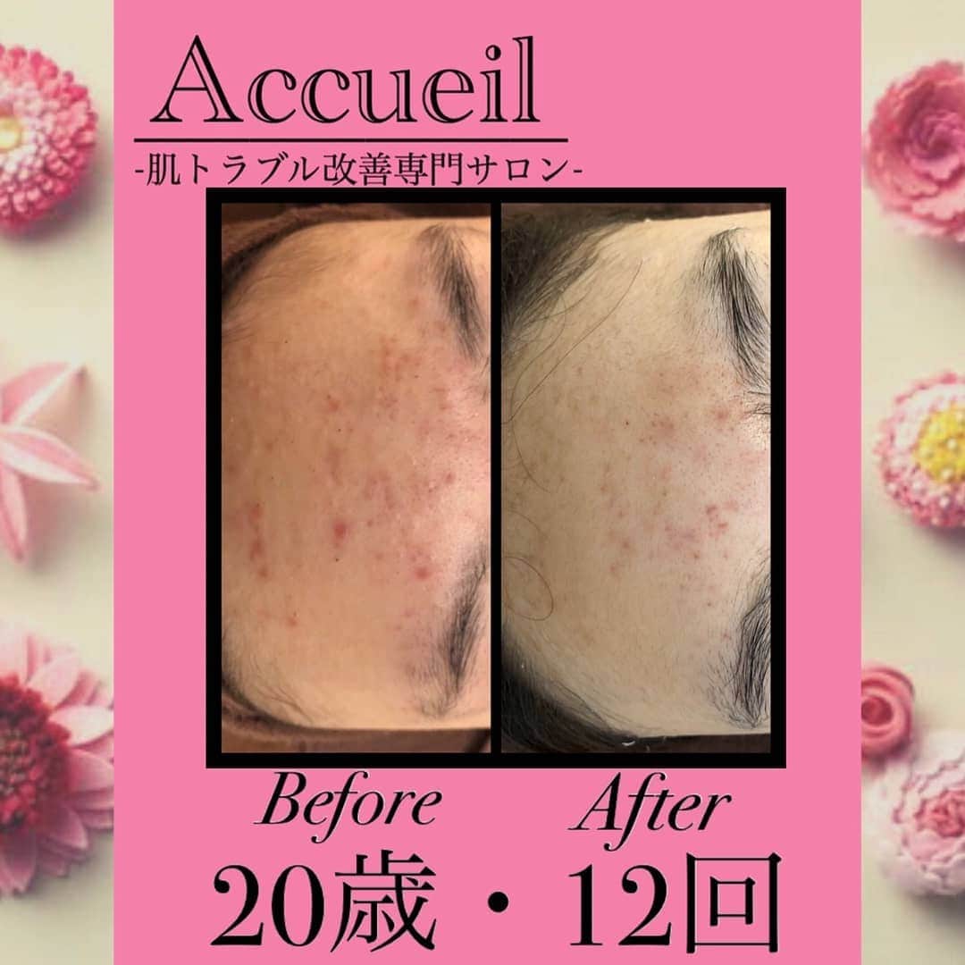 肌質改善専門サロン~Accueil~のインスタグラム