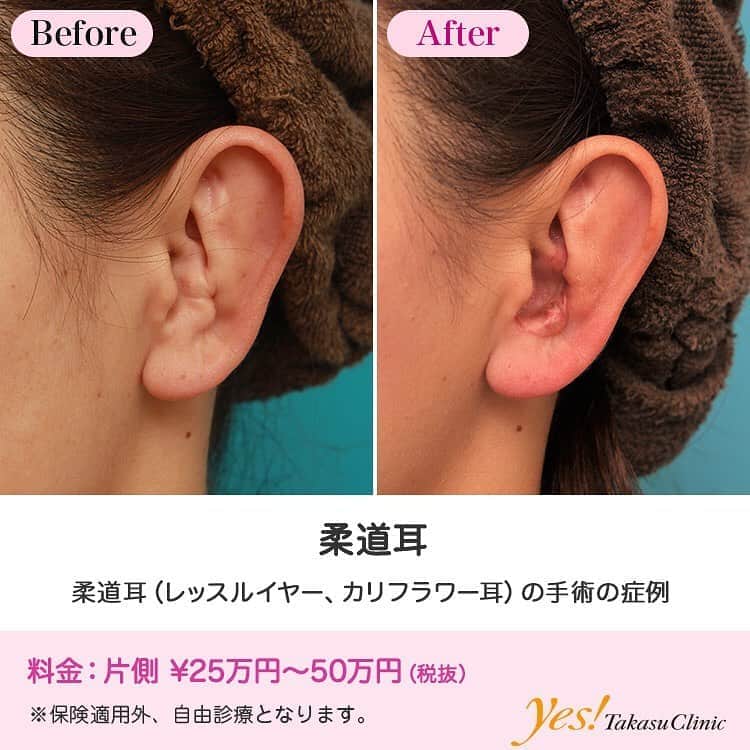 解明 楽しむ 妻 耳 軟骨 ぶつけ た 魅力的 ポインタ ビバ