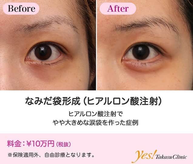 高須クリニックさんのインスタグラム写真 高須クリニックinstagram 高須幹弥医師からのコメント 代女性の患者様で 涙袋のヒアルロン酸注射を希望されていました 診察させていただいたところ 元の涙袋はわずかしかなく 少し眼輪筋の盛り上がりが
