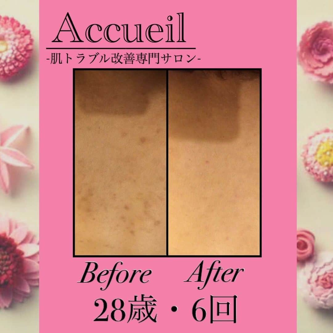 肌質改善専門サロン~Accueil~さんのインスタグラム写真 - (肌質改善専門サロン~Accueil~Instagram)「💙💚29・30日空きあり💛💜❤ * * 【ご予約はこちら👇🏼】 🌟🌟 @accueil_ikebukuro 🌟🌟 . ※今だけ期間限定クーポンあり . . . 肌荒れの原因は人それぞれなのにも関わらず、 周りの人と同じケアをしていませんか💦？？ * ❌お薬を塗っても飲んでも変わらない、、 ❌食事を気にしても肌が荒れる、、 ❌スキンケアを変えてもイマイチ、、 ❌何かしら常にトラブルが肌にある、、 ❌ニキビが繰り返しできる、、 * * そのお悩み解決できちゃいます😌✨ Accueilは、どのサロンに行っても良くならなかったお客さまたちや、 どの皮膚科に行っても変化がなかったお客さまたちが多く訪れてくださっています🙌💕* * * * もう悩まない！！！ 繰り返さないところまでしっかりと根本改善していきます☺️ そろそろ肌荒れから卒業しませんか？ * →→→初回体験はこちらから👉🏼 @accueil_ikebukuro * * * * Accueilでのお手当は、、 * 機械は一切使いません🙅‍♀️❌ 使うお化粧品は １００％天然の「ミネルヴァ化粧品」🌲🍃 ニキビの炎症がある方・アトピーの方でも 安心して受けていただける事ができる お肌にとても優しいエステです♡♡ * * お肌のお悩みなら、何でもお任せください😊💕 * * ■「インスタ見ました！」 で、 初回体験￥26,000 →→✨￥５，９８０✨ * * * --------当サロンのご予約方法≫--------- *  1️⃣当サロンのインスタTopのURL ⭐『Hotpepper Beauty』の 「instagram限定クーポン」にてご予約可能♡♡ * * 2️⃣インスタのDMからご予約 （下記項目を記載の上、お問い合わせください♪） * 🔶お名前（フルネーム） * 🔶お電話番号 * 🔶希望日時（第１～第３希望） * 🔶ご希望のメニュー * * 3️⃣お電話でのご予約✨ 　03-6912-5705にお願いします♡ ----------------------------------------- * * @accueil_ikebukuro ✨ #ニキビ #ニキビ跡 #毛穴 #乾燥肌 #ニキビ跡ケア #肌荒れ #ニキビ跡改善 #ニキビ肌改善 #ニキビ治療 #保湿 #毛穴の黒ずみ #毛穴の開き #スキンケア #毛穴吸引 #アトピー女子 #ニキビ皮膚科  #美肌ケア  #ニキビ専門 #肌質改善 #背中ニキビ #アトピー肌 #乾燥 #ニキビケア #毛穴ケア #アトピー治療 #肌悩み #スキンケア難民 #肌トラブル改善 #スキンケア大事 #目指せ美肌」1月29日 22時55分 - accueil_ikebukuro