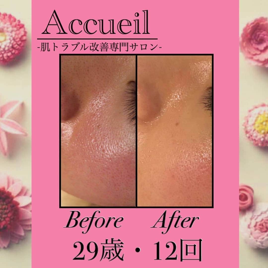 肌質改善専門サロン~Accueil~さんのインスタグラム写真 - (肌質改善専門サロン~Accueil~Instagram)1月30日 19時56分 - accueil_ikebukuro