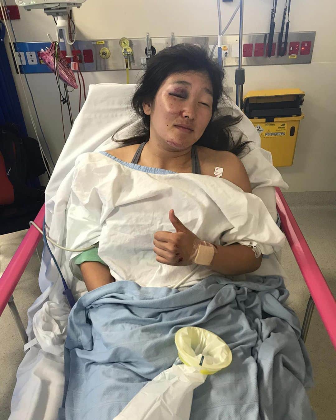 畠山紗英のインスタグラム：「So this is what happened 2 weeks ago when I was doing training in Australia🤕  It was windy and a strong wind blew me up suddenly when I jumped.  I hit my head pretty hard but it was luckily just a concussion.  I have already recovered from the concussion now but I also broke my hand so I can’t race next 4 World Cup rounds ☹️ I can’t wait to get back on my bike!! 2週間ほど前、オーストラリアでのコース練習中、強風に煽られ転倒してしまいました。 頭を強く打ったため脳震盪と手の骨折をしてしまい日本で治療をしています。 今週末から行われるワールドカップ第1〜4戦の出場は断念しました。 現在は回復し、トレーニングを始めています！」
