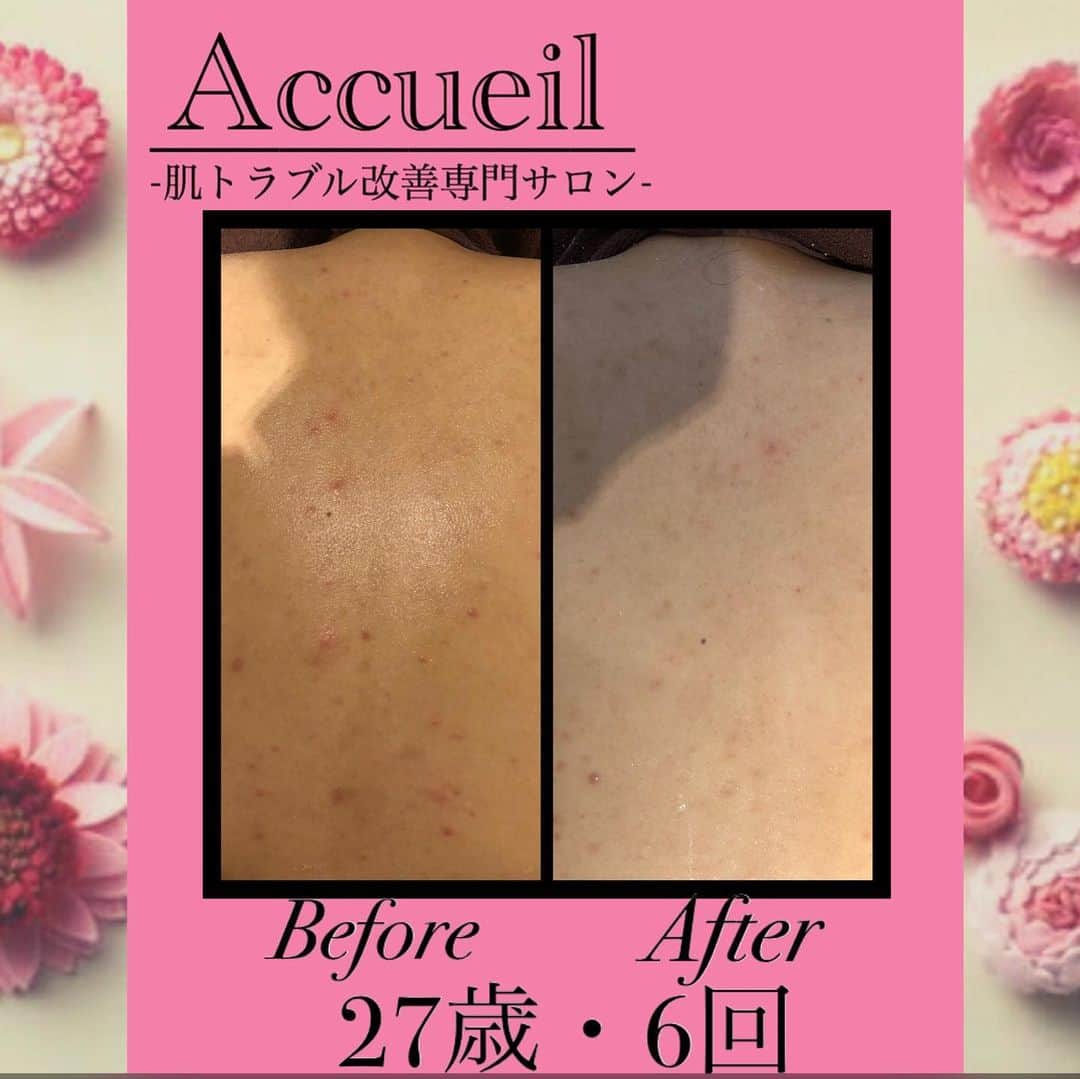 肌質改善専門サロン~Accueil~のインスタグラム