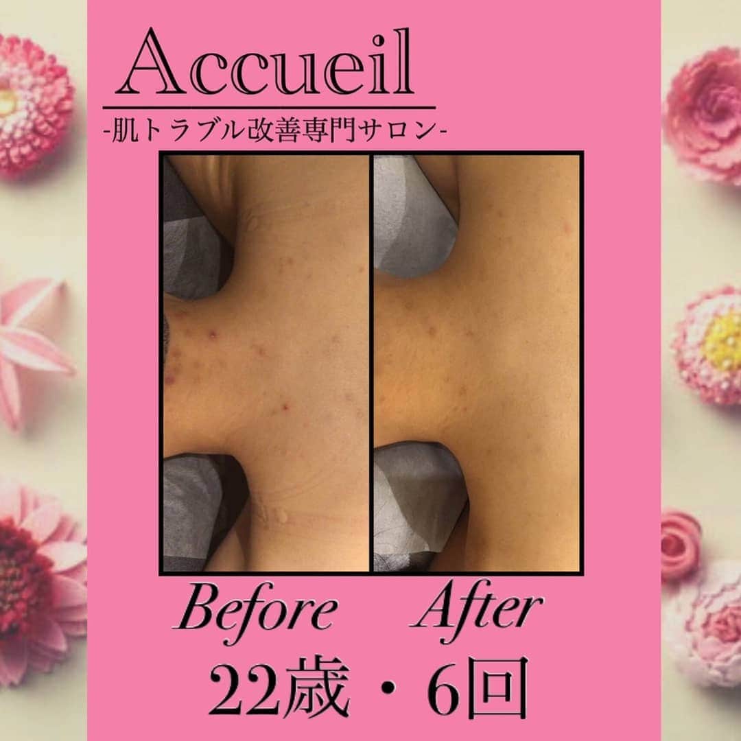 肌質改善専門サロン~Accueil~のインスタグラム