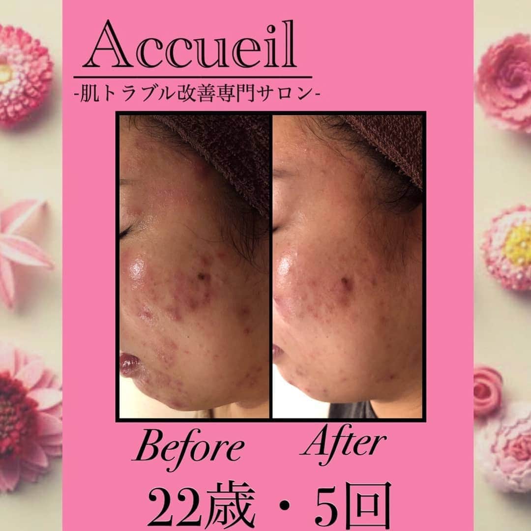 肌質改善専門サロン~Accueil~のインスタグラム