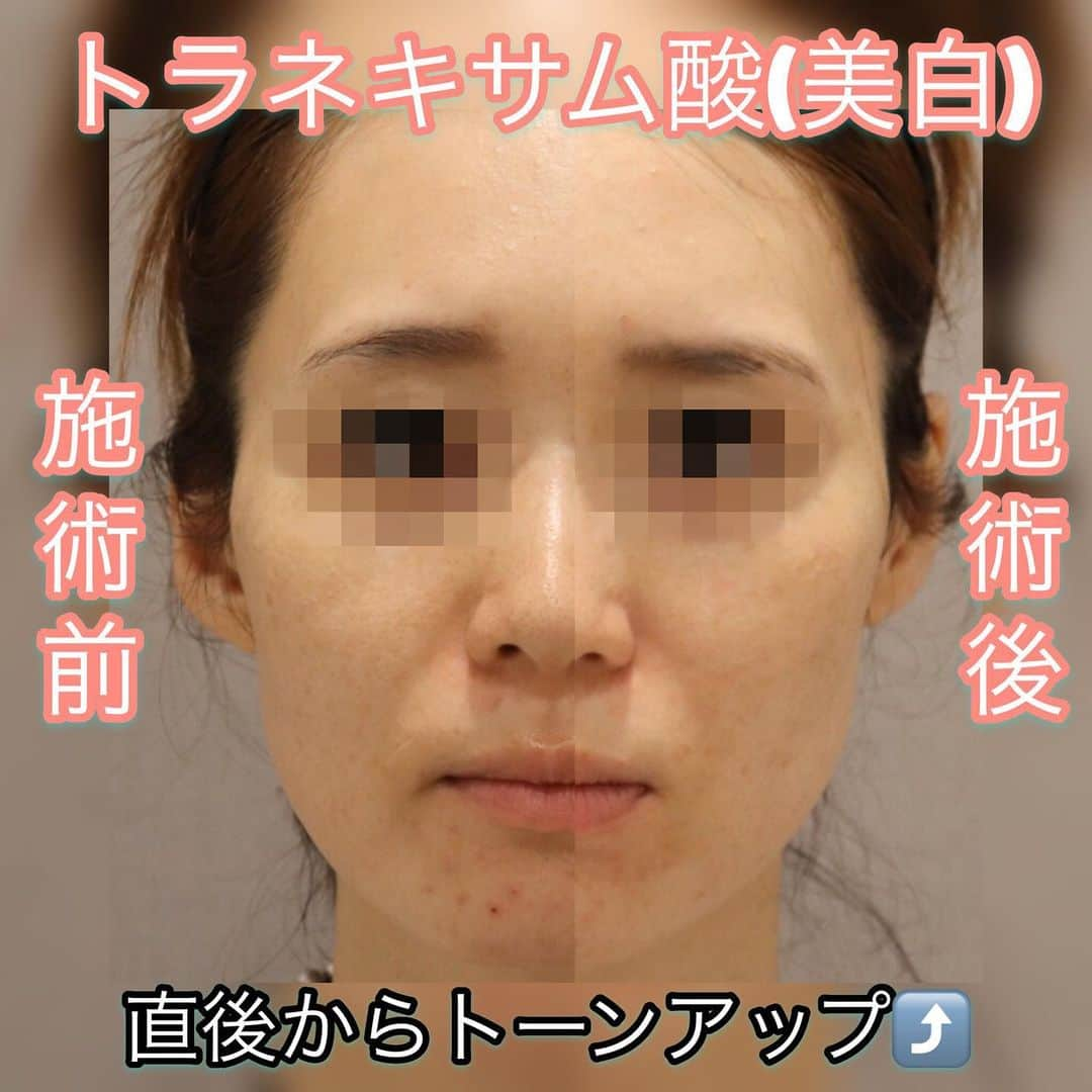 オラクル美容皮膚科東京新宿院さんのインスタグラム写真 - (オラクル美容皮膚科東京新宿院Instagram)「痛くない水光注射『メソナJプラス』﻿ 乾燥が気になる冬にGOODです✨﻿ ﻿ 直後から効果を実感いただける今大人気の施術♥﻿ ﻿ エレクトロポレーション法でお肌の深部まで美容成分が浸透するので﻿ しっかり効果を実感いただけます💓﻿ ﻿ お肌に優しくダウンタイムもないので﻿ ダウンタイムをとる時間がない方におすすめです💡﻿ ∴‥∵‥∴‥∵‥∴‥∴‥∵‥∴‥∵‥∴﻿ ﻿ メソナJプラスはお悩み別にお選びいただけます🌟﻿ 💎保湿﻿ 💎美白﻿ 💎ハリ・毛穴(ボトックスカクテル)﻿ 💎ハリ・保湿(リジュラン)﻿ 💎肌再生(リジュラン・幹細胞)﻿ 💎脂肪溶解・小顔(BNLS)﻿ ﻿ 初めての方はすべてトライアル料金でお試しいただけます😆﻿ ﻿ 〇限定メニューの『スノークイーン』も大好評🎉﻿ 人数限定ですのでお早めに🏃‍♀️残りわずかとなっております！﻿ 1回 24,000円(通常30,000円)﻿ ﻿ ∵‥∴‥∵‥∴‥∴‥∵‥∴‥∵‥∴﻿ ﻿ ⚠️リスクなど⚠️﻿ ・施術中に軽いピリピリ感を感じる場合があります。﻿ ﻿ ・電気による刺激やスティックによる摩擦での発疹、施術部位の赤み、かさつきなどが稀に起こる場合があります。﻿ ﻿ ∵‥∴‥∵‥∴‥∴‥∵‥∴‥∵‥∴﻿ ﻿ たくさんのお問合せお待ちしております✨﻿ ﻿ ﻿ #オラクル美容皮膚科 #美肌 #美白 #ハリ #リジュラン #幹細胞 #BNLS #水光注射 #最新美容 #メソナＪ #リジュラン #ボトックス #BNLS﻿ #美容 #美容皮膚科 #イオン導入 #ヒト幹細胞 #サーモン注射 # ノーニードル注射 #アンチエイジング #若返り #毛穴 #脂肪溶解 #顔痩せ #美白ケア #美容オタク #美容マニア  #美容好き #美容好きさんと繋がりたい」1月7日 17時00分 - oraclejp