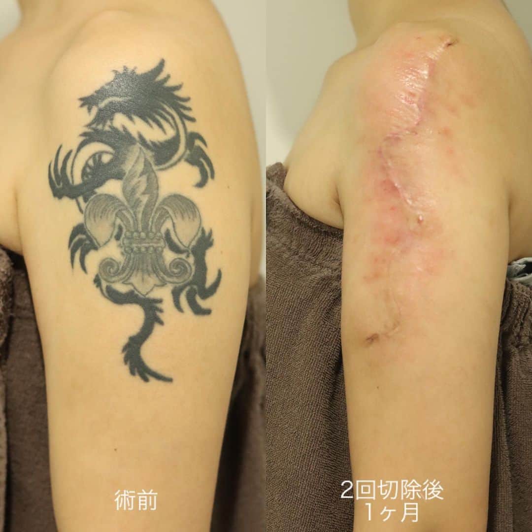 東京イセアクリニックさんのインスタグラム写真 - (東京イセアクリニックInstagram)「タトゥーの切除術 🙅🏻🙅🏻‍♂️ . 肩に入ったタトゥーをなるべく小さな傷での除去を 希望された患者様🗣🗣 ↓↓↓↓↓ 担当医師:ヨシタネ  @yoshitane_isea . 他院では切除は難しい為、 植皮をオススメされたという事でした💉 植皮は 🌟タトゥーが元々あった場所に火傷跡の様な傷跡 🌟皮膚を採取した部分にも傷跡 が出来てしまう為、切除術で除去しました👨🏻‍⚕️👩🏻‍⚕️️ . 写真左:before 写真右:after 2回切除1ヶ月 7日目〜14日目の間で抜糸となります🌟 . 👛タトゥーサイズ17×10cm¥544000〜 (サイズによって料金は変わります) . 😖麻酔の痛み →痛みが心配な方は笑気麻酔が使用出来ます🌟 ⚠️創部に鈍い痛み:1-2週間程度 ⚠️傷の赤み・引きつれ:3-6ヶ月 🌻テープ保護:3-6ヶ月 →綺麗な傷跡にする為にテープ保護が必要になります🌟 . . タトゥーを消すには理由が各々😖💦 患者さまのニーズに合わせた治療法を 提案いたします💁🏼‍♀️💁🏼‍♂️ . *他院で断られたけど消したい *傷跡を残さずにタトゥーを消したい *就職までにタトゥーを消したい *ダウンタイムなく安く消したい . LINEでもカウンセリングを承っております💌 お気軽にお問い合わせ下さい👩🏻‍⚕️✨ . #銀座#ginza  #iseaclinic#イセアクリニック #美容整形#美容外科#美容皮膚科  #吉種克之 #タトゥー#刺青#刺青除去#タトゥー除去#タトゥー切除 #tattoo #タトゥー女子#切除 #切除術 #植皮 #ピコ#ピコレーザー#picoway#モニター募集 #LINEカウンセリング#カウンセリング無料 #綺麗になりたい#可愛くなりたい」1月9日 13時41分 - iseaclinic
