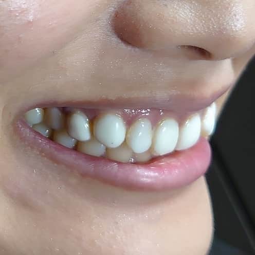 五十嵐一誠さんのインスタグラム写真 - (五十嵐一誠Instagram)「歯のマニキュアとスーパーベニア の比較  歯のマニキュアを僕がスーパーベニアで 直した写真です 写真上がスーパーベニア 下がマニキュア 「メリット」 スーパーベニア 希望の歯の形、大きさ、位置、色、 方向、歯茎の位置と形を可能な限り 美しい歯と歯並びを作れます 透明感と光沢があり変色やすり減りもほとんど ありません  マニキュア 歯を全く削らずに手軽に白い歯を 作れます 価格が安い １本１万円～４万円(当院調べ) 、 「デメリット」 スーパーベニア 基本的に歯の表面と側面を削らないと出来ません 価格が高い １本９万円(税抜き、治療費別) 、 マニキュア 写真のように自分の歯の上にそのまま厚く盛りますから歯の中心部だけがモッコリと白くなるので歯の周りの辺縁は茶色く縁取りしたように見えてしまいます 歯の形、大きさ、色、方向、歯茎の位置と形は変えられません 透明感と光沢はなく変色とすり減りが起こります  相談はDMからでも受付ます☺️ 、  #白い歯#きれい#白い歯になりたい #ホワイトニング#セラミック#ジルコニア #マニキュア#デンタルクリニック#歯科 #美人#美しくなりたい#小顔#美脚#メイク #エステ#ヨガ#歌舞伎町#銀座#六本木#ラウンジ #美容整形#歯並び#歯科矯正」1月9日 20時40分 - superdentist5