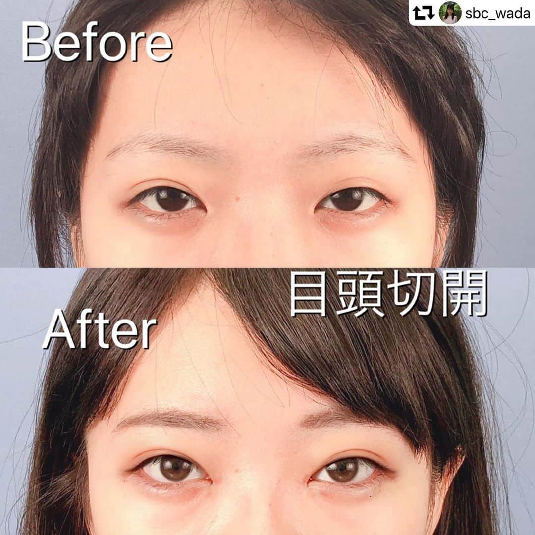 湘南美容外科 柏院さんのインスタグラム写真 湘南美容外科 柏院instagram Repost Sbc Wada ハーフ顔になりたい 綺麗な平行二重になりたい 大人っぽくなりたい そんな希望を叶えてくれるのが目頭切開 お顔のバランスを整えて 簡単に驚くほど可愛くなれ