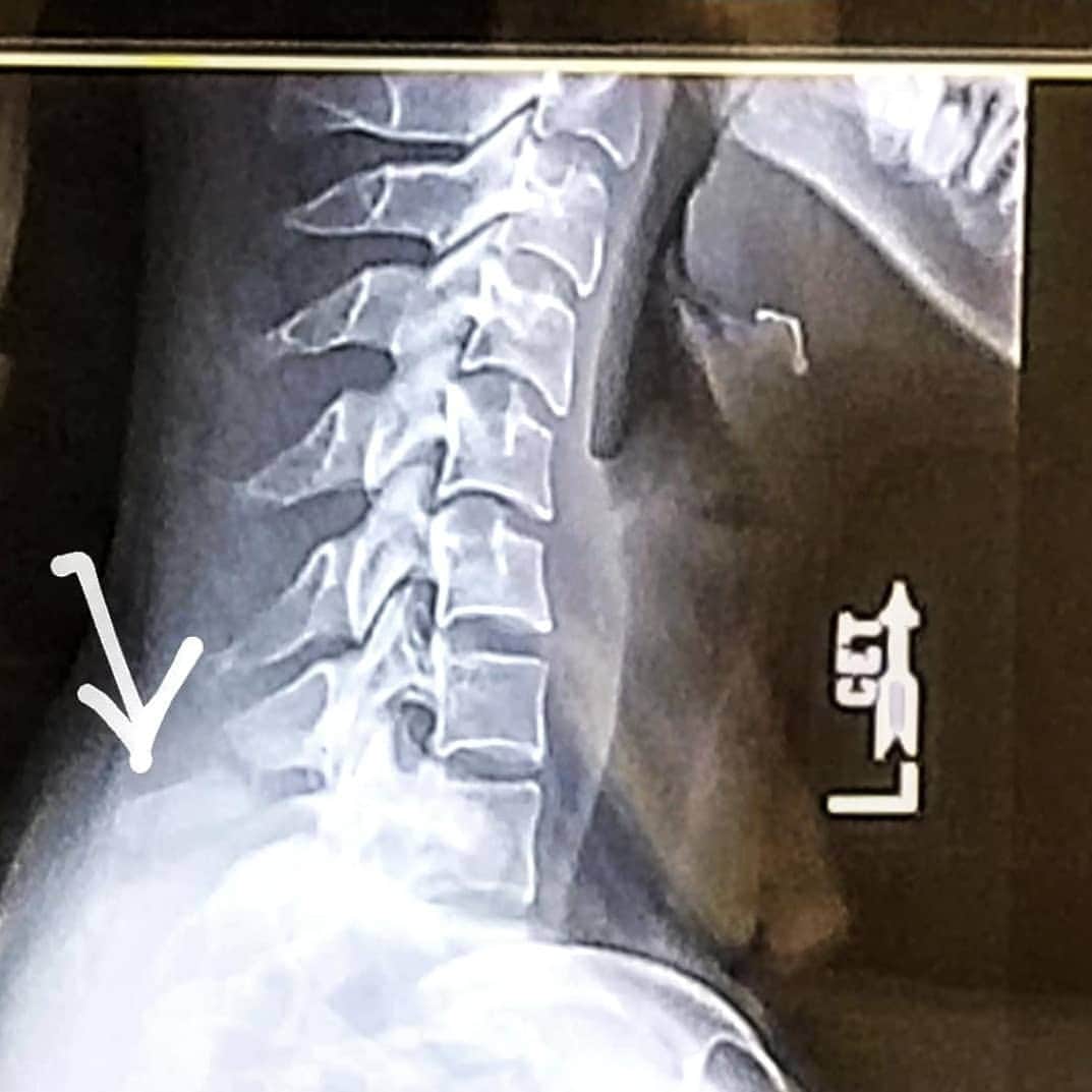 Lily Saito (齊藤莉理)のインスタグラム：「As some of you have already heard, I had accidentally fractured my C6 vertebrae this week. It was the first bone I have ever fractured/broke before but I am just grateful and lucky it was not any worse than it could have been. I'd just like to let you guys know that I will probably be out from dancing for a couple weeks as the bone needs time to heal on it's own without surgery. I am so grateful to have such amazing people surrounding me and offering such amazing support and care. I promise I will keep my chin up (lol) and heal this baby as soon as possible! Thanks for all of your concerns and love. 💜🙏🏻 #NewFashionTrend2020 #NeckBraceFashion 🤣」