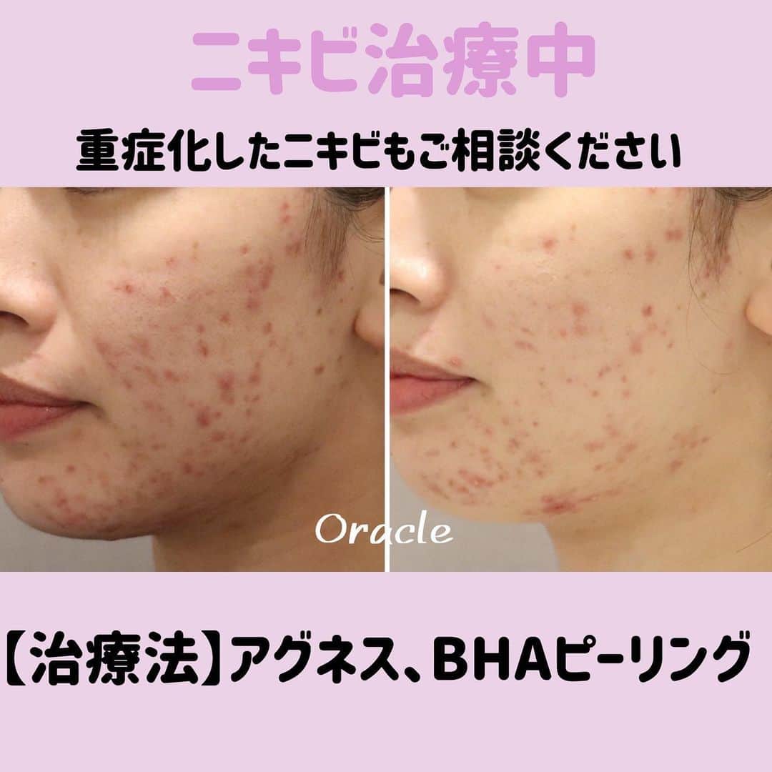 オラクル美容皮膚科東京新宿院さんのインスタグラム写真 - (オラクル美容皮膚科東京新宿院Instagram)「👩‍⚕️ニキビ専用治療👩‍⚕️﻿ オラクル美容皮膚科ではニキビの予防から重症化したニキビ治療まで幅広く専門的なニキビ治療を行なっております。﻿ ﻿ -+-+-+-+-+-+-+-+-+-+-+-+-﻿ ﻿ 写真の20代女性は、広範囲にニキビが広がった赤ニキビ﻿ BHAピーリング（ニキビ専用ピーリング）を3回、現在アグネスによる治療を併用して治療中です。﻿ ニキビの凸凹が治まり、ハイドラフェイシャルも可能になっため今後はハイドラフェイシャルも行います。﻿ ﻿ -+-+-+-+-+-+-+-+-+-+-+-+-﻿ ﻿ 👩‍⚕️BHAピーリング 1回　10,000円（税抜）﻿ ※面ぽう圧出、ゴムマスクつき﻿ ﻿ ﻿ 👩‍⚕️本格ニキビ治療【アグネス】⚡️﻿ ﻿ 初回限定 18,000円（税抜）﻿ 片側:顎、頬、こめかみ、1箇所:鼻﻿ ※麻酔代別﻿ ﻿ アグネスのすごいところ！！﻿ 👉選択的皮脂腺の破壊⚡️﻿ ＝ニキビをピンポイントで壊す⚡️﻿ ﻿ だから根本的改善が期待！﻿ ﻿ ﻿ -+-+-+-+-+-+-+-+-+-+-+-+-﻿ ﻿ その他、メソナJニキビ撃退コース、マスクミルクピーリングなど各種ピーリング、内服、点滴などのメニューもございます。﻿ ﻿ まずはお気軽にご相談ください。﻿ ﻿ ▪️▫️▪️▫️▪️▫️▪️▫️▪️▫️﻿ ﻿ 🇯🇵オラクル美容皮膚科🇰🇷﻿ 📍新宿3丁目19-4 MLJ新宿8階﻿ ﻿ 【専門】﻿ ニキビ（跡）／毛穴／シミ／しわ／たるみ／痩身／アンチエイジング／美白美肌全般／ブライダル相談﻿ ﻿ 🗝完全予約制﻿ 👠土日祝日も診療﻿ ﻿ 【予約方法】﻿ ☎0120-905-696﻿ ⏰9:00～21:00［年中無休］﻿ ﻿ LINE、メール24時間📧﻿ LINE🆔 @oracle.jp ﻿ 📩HPメールフォームよりお願いいたします﻿ ﻿ ▪️▫️▪️▫️▪️▫️▪️▫️▪️▫️﻿ #オラクル美容皮膚科 #オラクル ﻿ #oracle #美容皮膚科 ﻿ #メディカルエステ #皮膚管理 ﻿ #ニキビ #ニキビ跡 #ニキビ治療 #アグネス #ニキビケア #ニキビ跡ケア #ニキビ肌 #ニキビ改善 #ニキビ専門 #ニキビ皮膚科」1月12日 12時21分 - oraclejp