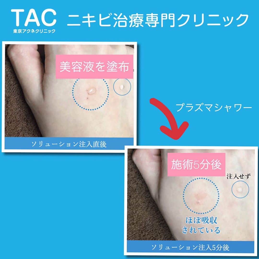 東京アクネクリニックさんのインスタグラム写真 - (東京アクネクリニックInstagram)「～『プラズマシャワー』でお肌に合わせた美容成分を導入～﻿ ﻿ プラズマシャワーは、針を使わず痛みの少ない施術です。﻿ お肌の悩みに合わせた美容液を導入することで、理想の肌へ導きます﻿✨ ﻿ ☑️ニキビ改善﻿ ☑️肌質改善﻿ ☑️小じわ・たるみ改善﻿ ☑️くすみ改善﻿ ﻿ などに効果があります💚﻿ ﻿ 【料金】﻿ トライアル　部分　8,000円+税﻿ 全顔　1回　30,000円+税～﻿ ﻿ 【主な美容成分】﻿ ・ビタミンC﻿ ・トラネキサム酸﻿ ・ボトックス﻿ ・サイトプロMD﻿ ・プラセンタ﻿ ﻿ ﻿ プラズマシャワーに関するお問い合わせは下記まで﻿ ﻿ +:-:+:-:+:-:+:-:+:-:+:-:+:-:+:-:+:-:+﻿ ﻿ 🏥東京アクネクリニック﻿ ﻿ 📲フリーダイヤル　0120-90-5541﻿ ※コールセンター受付時間 9:00～21：00﻿ ﻿ お問い合わせはプロフィールのURLから💻﻿ +:-:+:-:+:-:+:-:+:-:+:-:+:-:+:-:+:-:+﻿ ﻿ #ニキビ #大人ニキビ #吹き出物 #ニキビ跡 #ニキビ肌改善 #ニキビ治療 #肌荒れ #ニキビケア  #肌荒れ改善 #美肌治療 #美肌 #美肌ケア #美容皮膚科 #皮膚科 #エステ #ピーリング #肌質改善 #すっぴん #スキンケア #ニキビ予防﻿ #赤ニキビ　#黒ニキビ　#黄ニキビ﻿ #ニキビ治療専門　#プラズマシャワー  #ビタミンC #トラネキサム酸 #ボトックス #サイトプロMD #プラセンタ」1月14日 16時41分 - nikibi.c