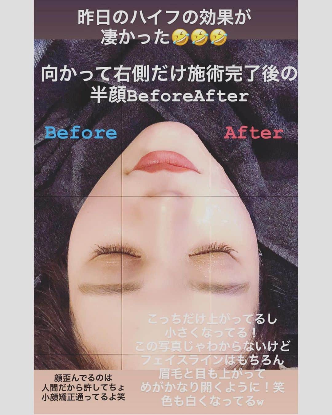 junko onagi ／小梛準子さんのインスタグラム写真 - (junko onagi ／小梛準子Instagram)「ㅤㅤㅤㅤㅤㅤㅤㅤ ストーリーにビフォーアフター載せたら 大反響だった @eyecandyhifu ❤︎ ㅤㅤㅤㅤㅤㅤㅤㅤ 詳しく知りたい方が多いと思うので まとめてみました✔️ ㅤㅤㅤㅤㅤㅤㅤㅤ まず効果としては3〜5枚目 顔の右側のみ施術後です！ 小さくなって上がってます❤︎ 肌も白くなって目も軽くなって 開きやすくなりました！  あと、気になってた痛みですが もちろん痛さは都度確認しながら 痛くない範囲でやってくれるので 肌をちょこっとはじかれてる程度でした！ 動画にもあるように喋れるくらい笑  そして、料金なのですが 顔の上か下半分どちらかが初回4400円 とかなりお財布に優しいお値段…👛💯 全顔だとしても続けられる価格でした！ 月1で行くのが良いそうで、わたしもまた行く予定♪  #eyecandyhifu #eyecandy #ウルトラVハイフ #ハイフ #HIFU #小顔 #リフトアップ #フェイシャル #エステ #美容 #たるみ改善 #毛穴 #痩身 #じゅこ美活記録」1月17日 17時16分 - jnco0417