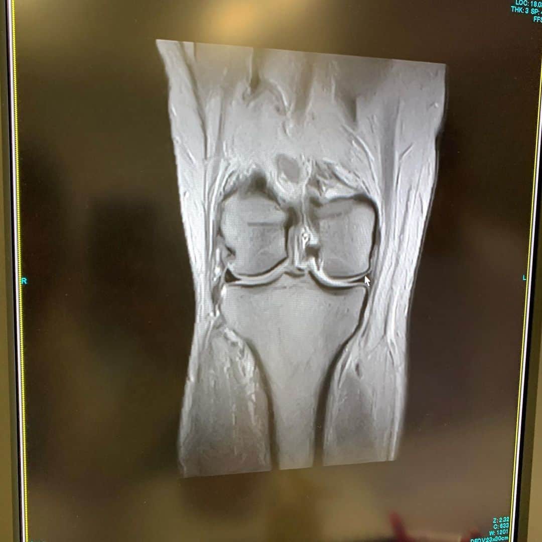 橋本志穂さんのインスタグラム写真 - (橋本志穂Instagram)「MRIを撮ることにー  膝がなぜ痛いのか、、、 結局のところ、 半月板に異常もなく〜。 健康なのは嬉しいけど これだけ痛くて、 こんな時間とお金かけて 何もないと うーーーん、、、って 拍子抜けしてしまう。」1月21日 1時22分 - shihohashimoto3