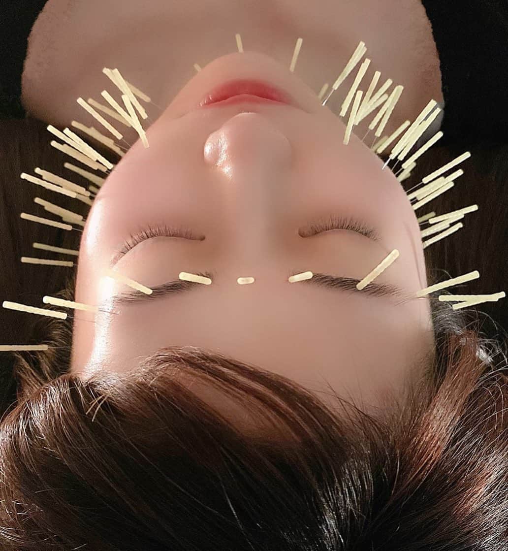 月中秋実さんのインスタグラム写真 - (月中秋実Instagram)「・ ・ はじめて美容鍼してもらいました😨 痛いイメージだったけど、最初だけで 刺したあとは、笑えるくらいに余裕でした。😂 ・ ・ 顔がすごく引き締まった感じ💗　 内臓の改善、ニキビ肌の改善に期待大です！ また行く。美容星人になりそう。🤭 ・ ・ 代官山駅の近くにある @daikanyama_medicalさん とてもとても、素晴らしい先生でした。✨ ・ ・ #代官山#代官山メディカル整体院 #美容#美容鍼#美容針#整体#動画#ムービー#笑#最初#痛い#チクチク#ハリネズミ#でも#全然#余裕#素晴らしい#顔#引き締め#効果#効果抜群#さすが#流石#一流#先生#施術#ゴッドハンド #おすすめ#紹介#インフルエンサー」1月21日 15時34分 - tukinakaakimi