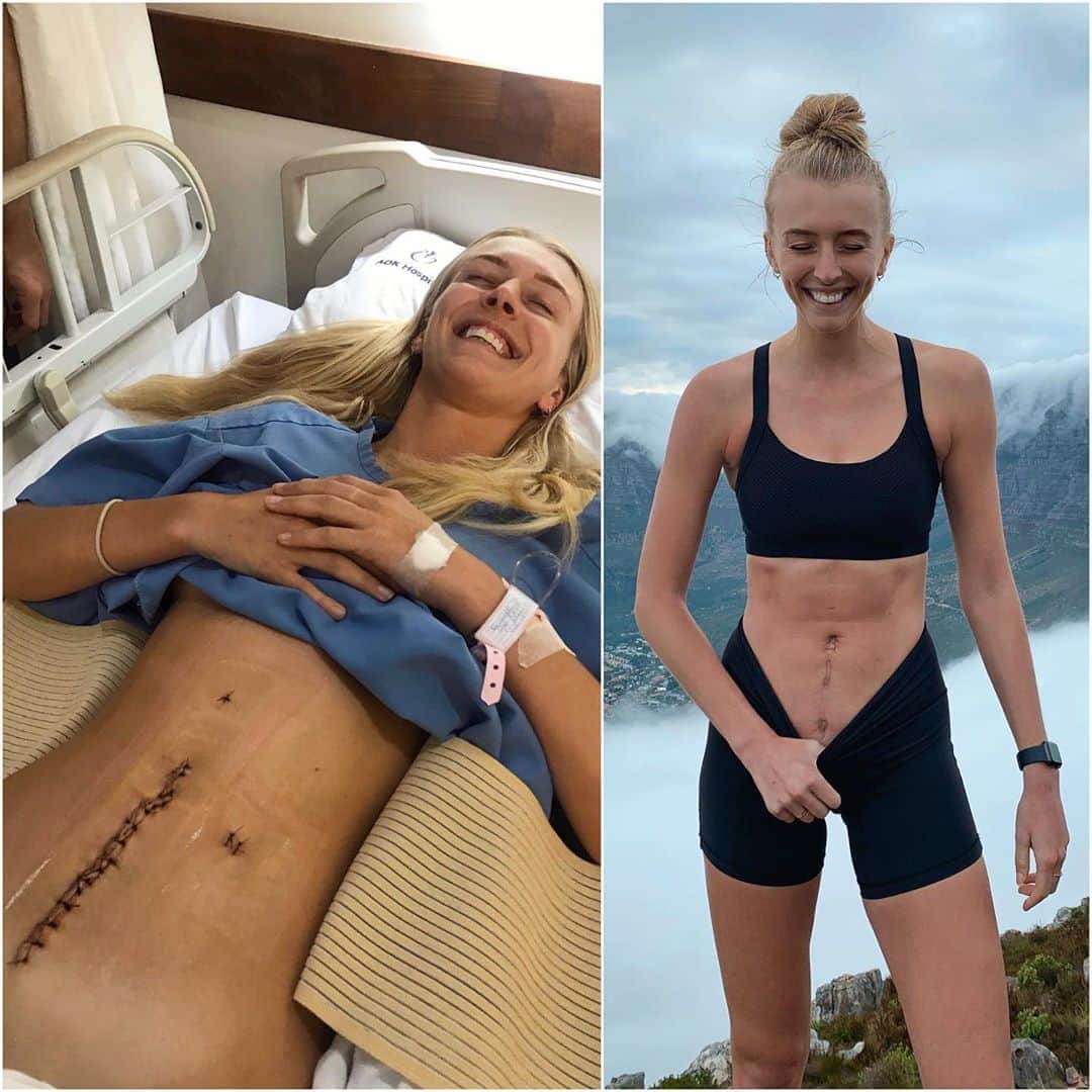 Zanna Van Dijkさんのインスタグラム写真 - (Zanna Van DijkInstagram)「One year ago vs now ✨ Today is my one year emergency bowel surgery anniversary. The day where I almost had my life taken away from me 💉 And you know what? If I could go back, I wouldn’t change a thing. I am SO grateful that it happened. It made me take a step back and find joy in the little things: being able to walk, to stand, to sit up unassisted. It made me resilient. It made me strong. It made me grow in ways I never expected. It reignited my passion for fitness. It made me connect more deeply with those around me. It made me love and respect my body more than ever before. I know it sounds crazy, but it made me happier 🥰 The way I see it, I was assigned this mountain to show it can be moved. And damn, I moved it. I’m proud of that ❤️ #bowelsurgery #emergencysurgery #beforeandafter #cecalvolvulus #positivity #positivemindset #operationcomeback #icandoanything #selfbelief #scarsarecool #scarredandproud #scarshowstrength」1月22日 18時48分 - zannavandijk