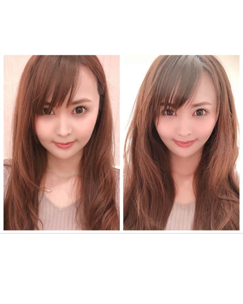 望月美穂のインスタグラム：「@a_clinic_ginza @dr.komatsu_rui ACLINICで1年ぶりのAスレッド〜♡ 今回は3本ずついれてもらいました(*´д`*) 目に見えて上がる幸せ！！ 糸入れただけで目も大きく見える♡ . 今年はダイエットとアンチエイジング頑張りますっ！✨ . #aclinic #aスレッド」