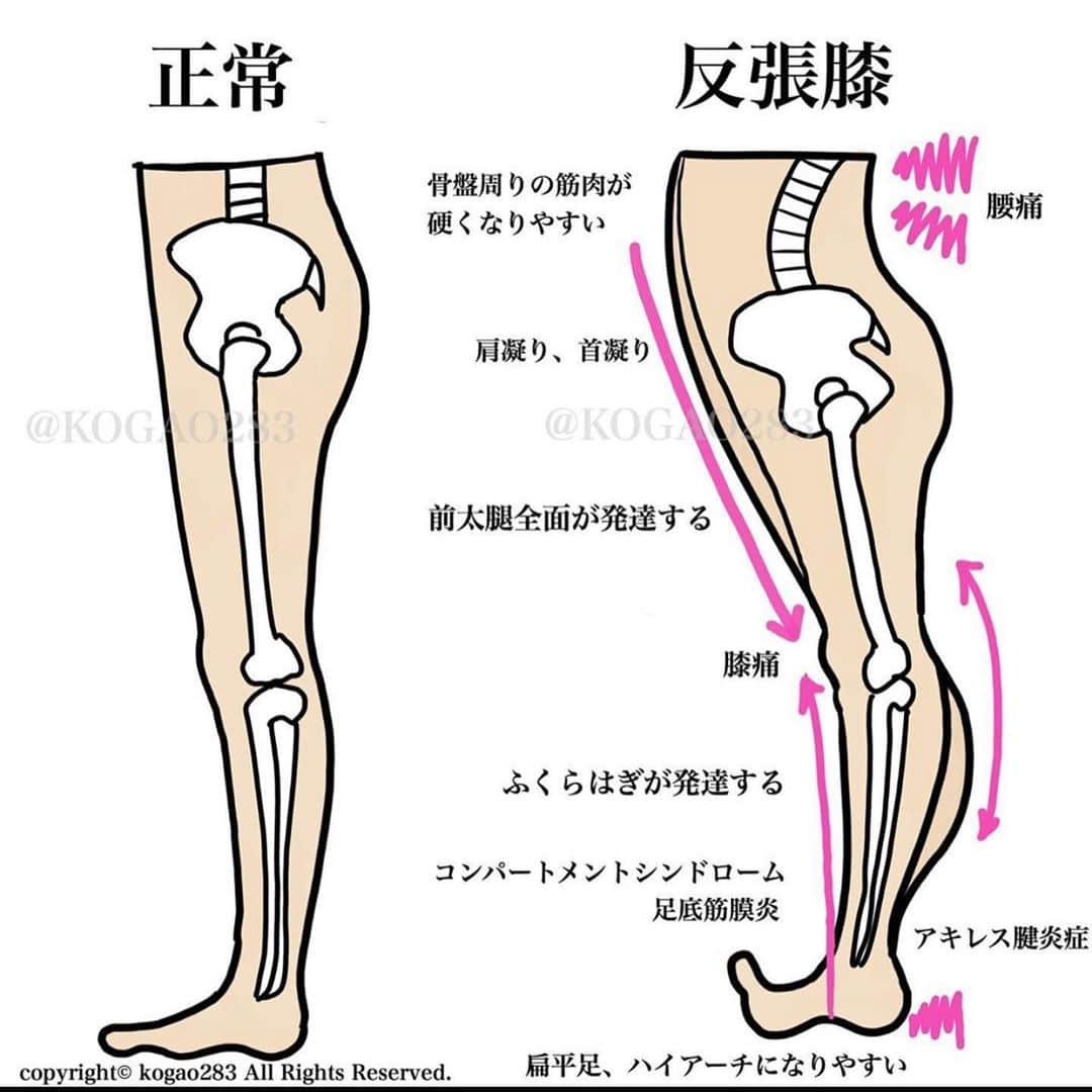 kogao283さんのインスタグラム写真 - (kogao283Instagram)「反張膝 改善 ストレッチ①  反張膝の方は 画像の通り身体の不調が多く 特に ふくらはぎ(腓腹筋)の伸びが悪く硬くなってる場合が多いです😭  2枚目のように先ずは 硬くなってしまったふくらはぎのストレッチを行ないましょう☝️ #ストレッチ#脚やせ#美脚#美脚トレーニング」2月22日 9時02分 - kogao283