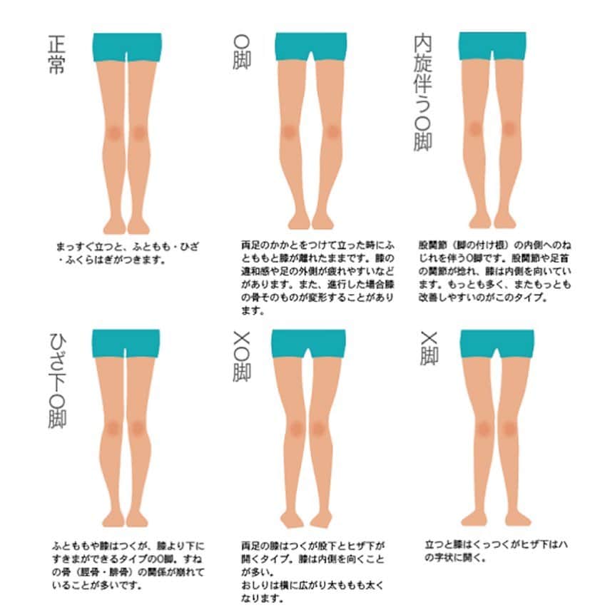 金子エミさんのインスタグラム写真 - (金子エミInstagram)「「内反膝（ないはんしつ）とは Ｏ脚🦵の事を言います。 Ｏ脚にも色々なタイプがあります。 自分の脚を知って応じたケアをしてみよう。 ☆ ☆ #フォトグラファー #小池勇輝  #kikonas #パーツモデル #金子エミ　#legcare #レッグケア　#脚　🦵🦶」2月22日 23時00分 - emikaneko1114