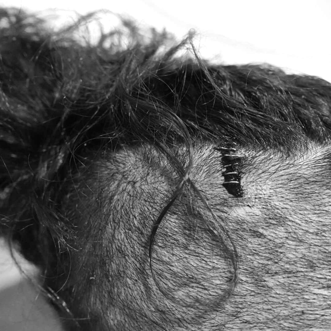 WWEさんのインスタグラム写真 - (WWEInstagram)「Graphic warning: @shinsukenakamura received nine staples to the head after last night’s brutal #SymphonyOfDestruction match. #SmackDown」2月23日 9時18分 - wwe